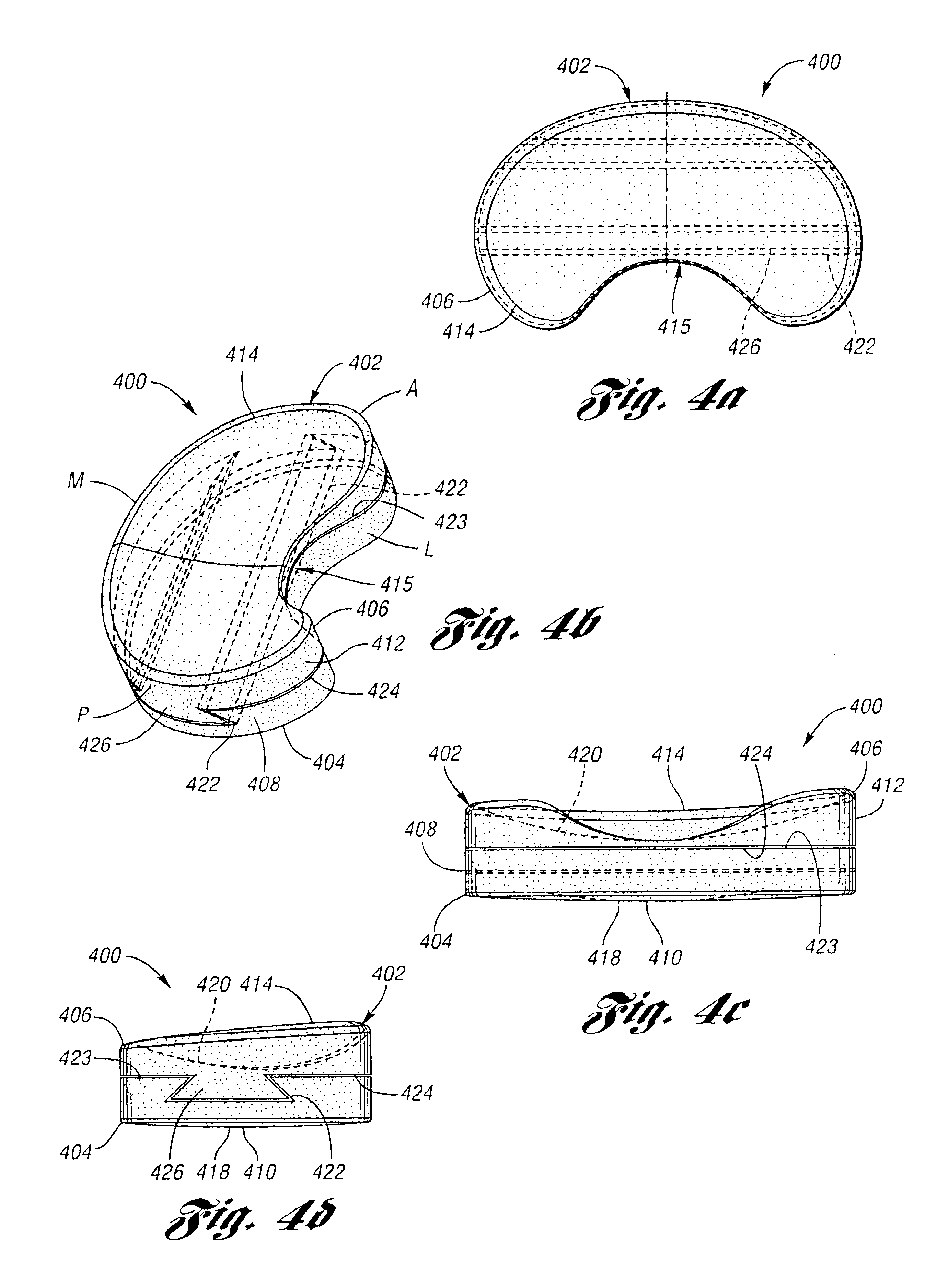 Surgically implantable knee prosthesis having two-piece keyed components