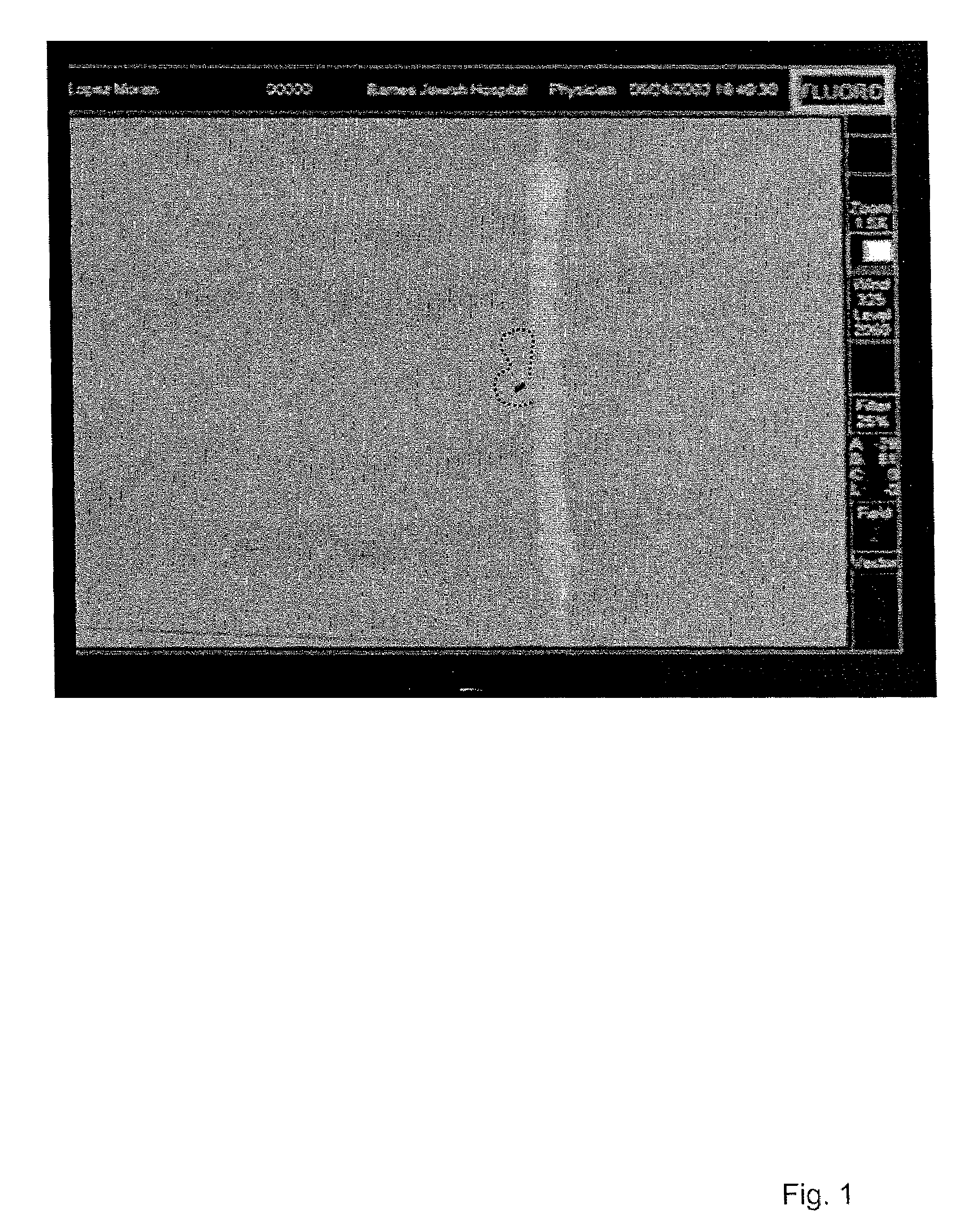 Method of navigating medical devices in the presence of radiopaque material