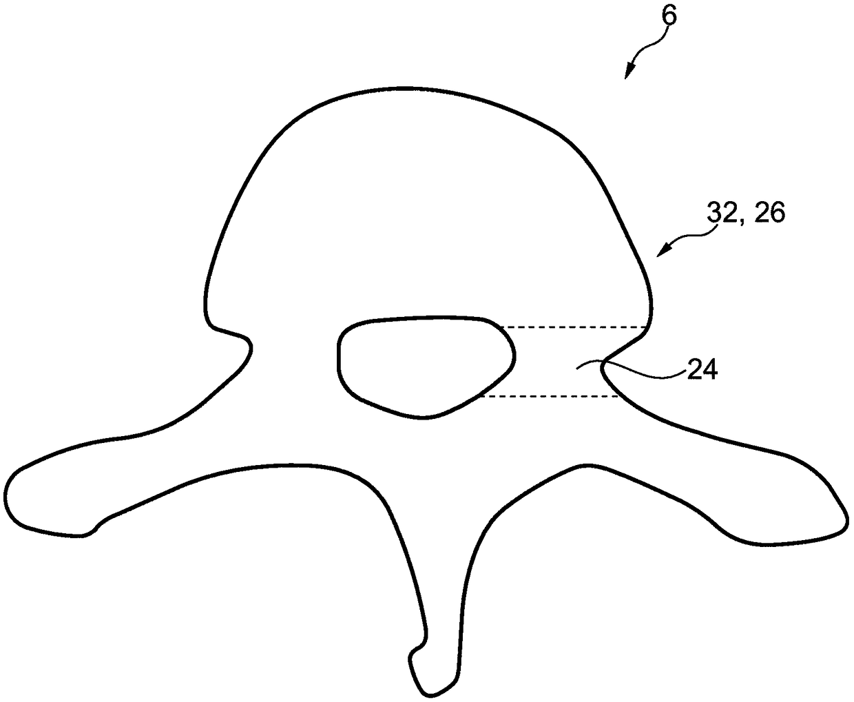 Determining an optimal placement of a pedicle screw