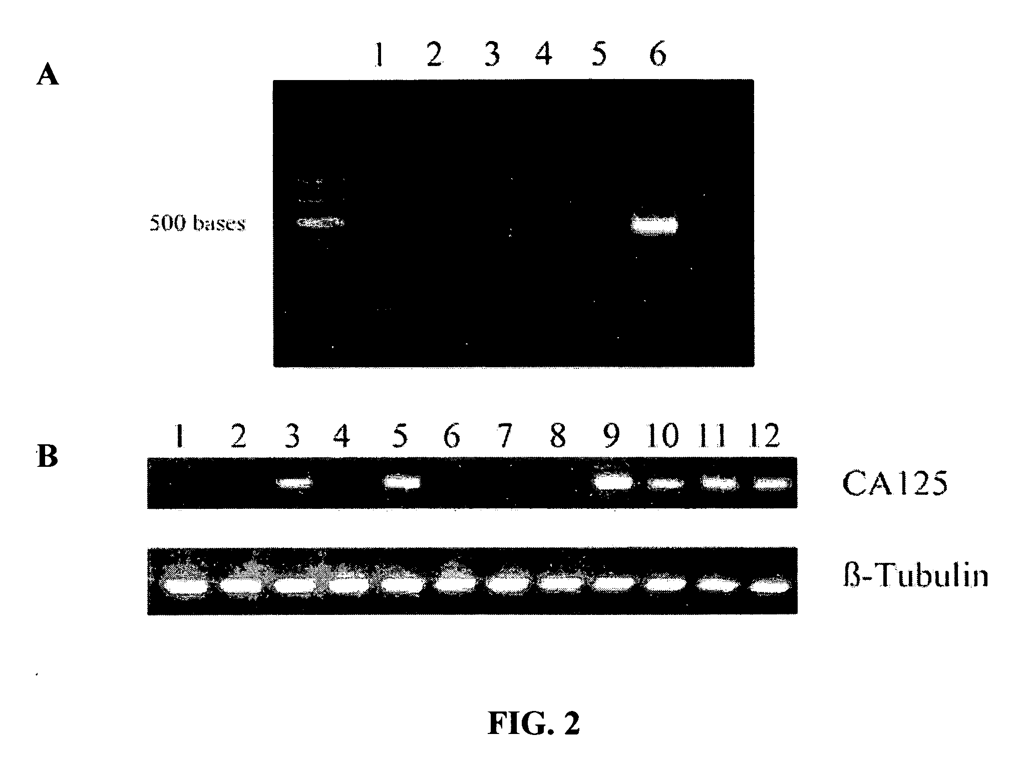 CA125 gene and its use for diagnostic and therapeutic interventions