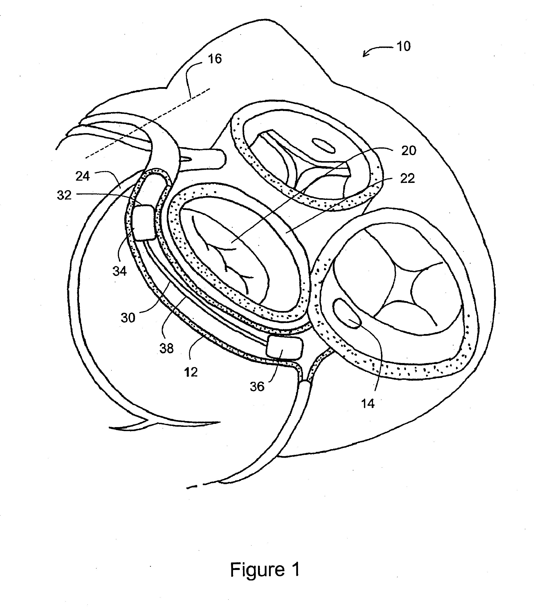 Tissue Shaping Device with Integral Connector and Crimp