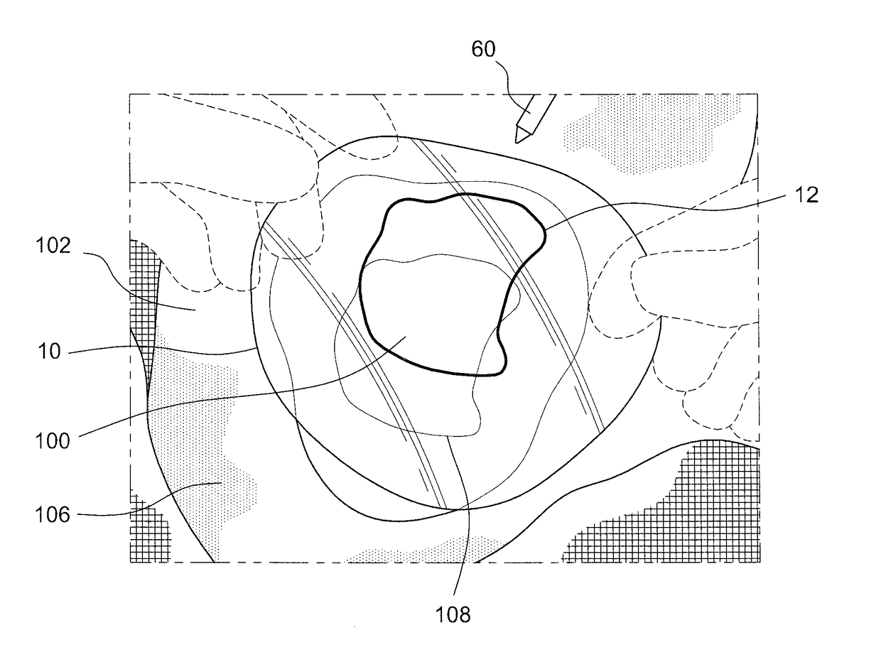 Method for performing single-stage cranioplasty reconstruction with a clear custom cranial implant