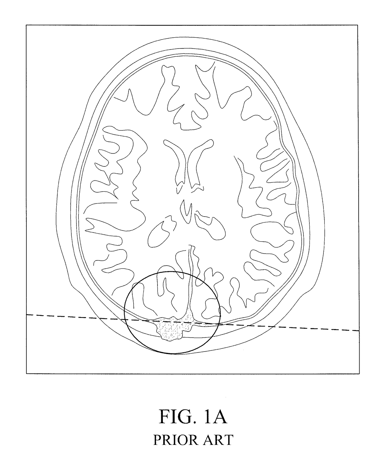 Method for performing single-stage cranioplasty reconstruction with a clear custom cranial implant