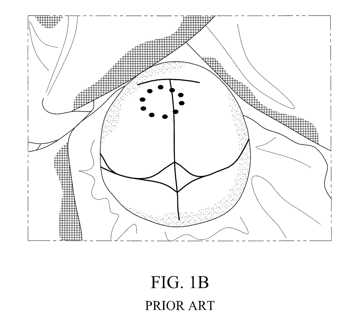 Method for performing single-stage cranioplasty reconstruction with a clear custom cranial implant