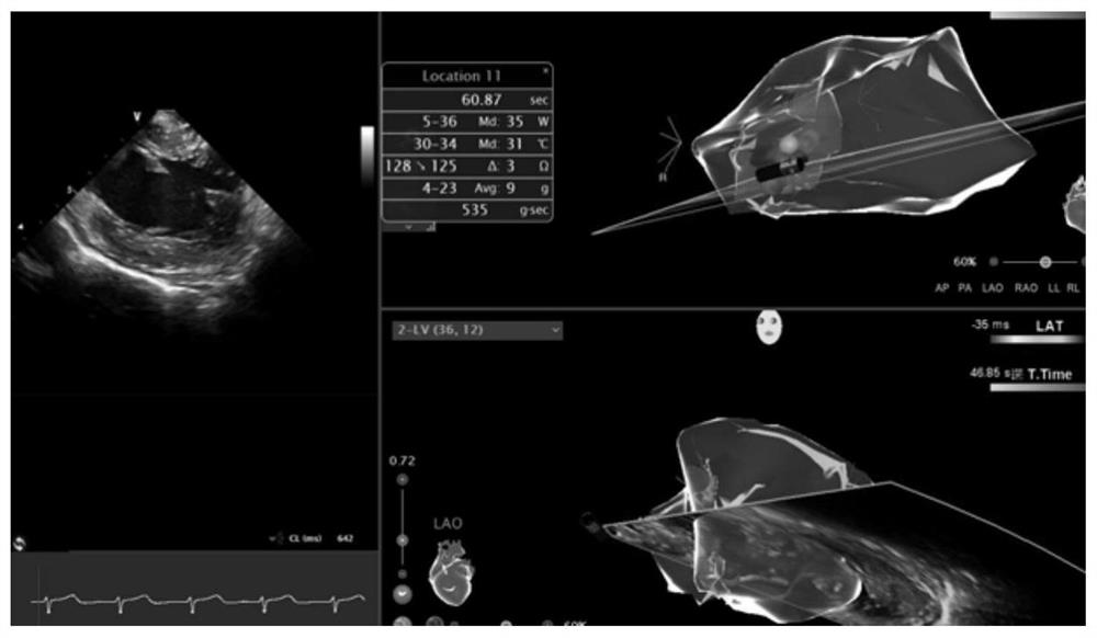 System for displaying trans-aortic valve pressure in real time in ventricular septum ablation