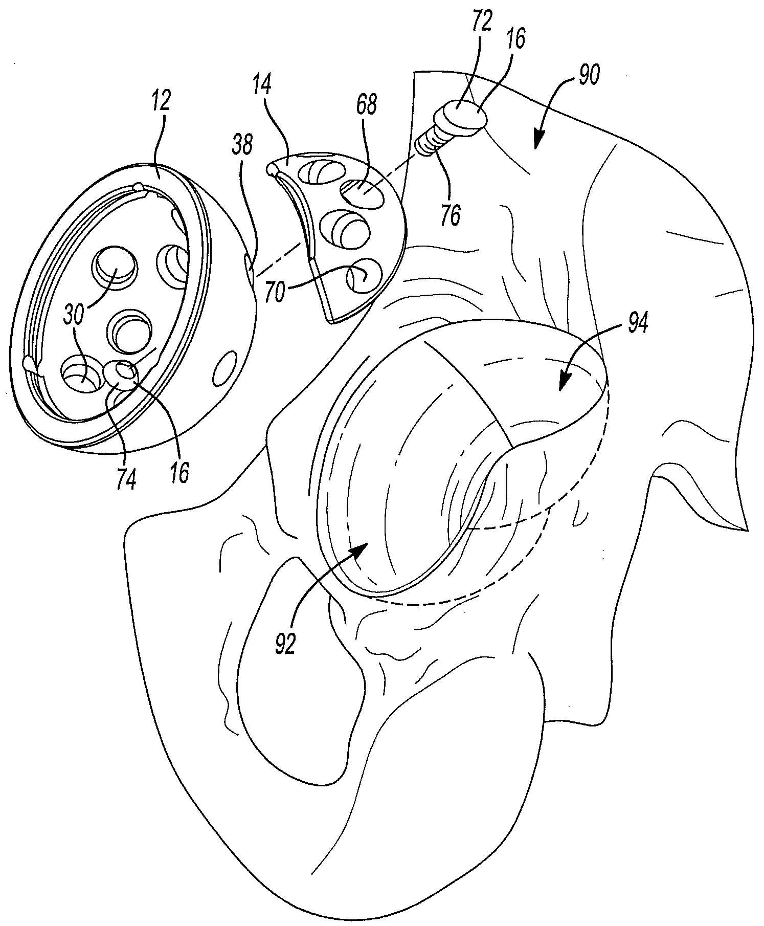 Acetabular Cup Having An Adjustable Modular Augment