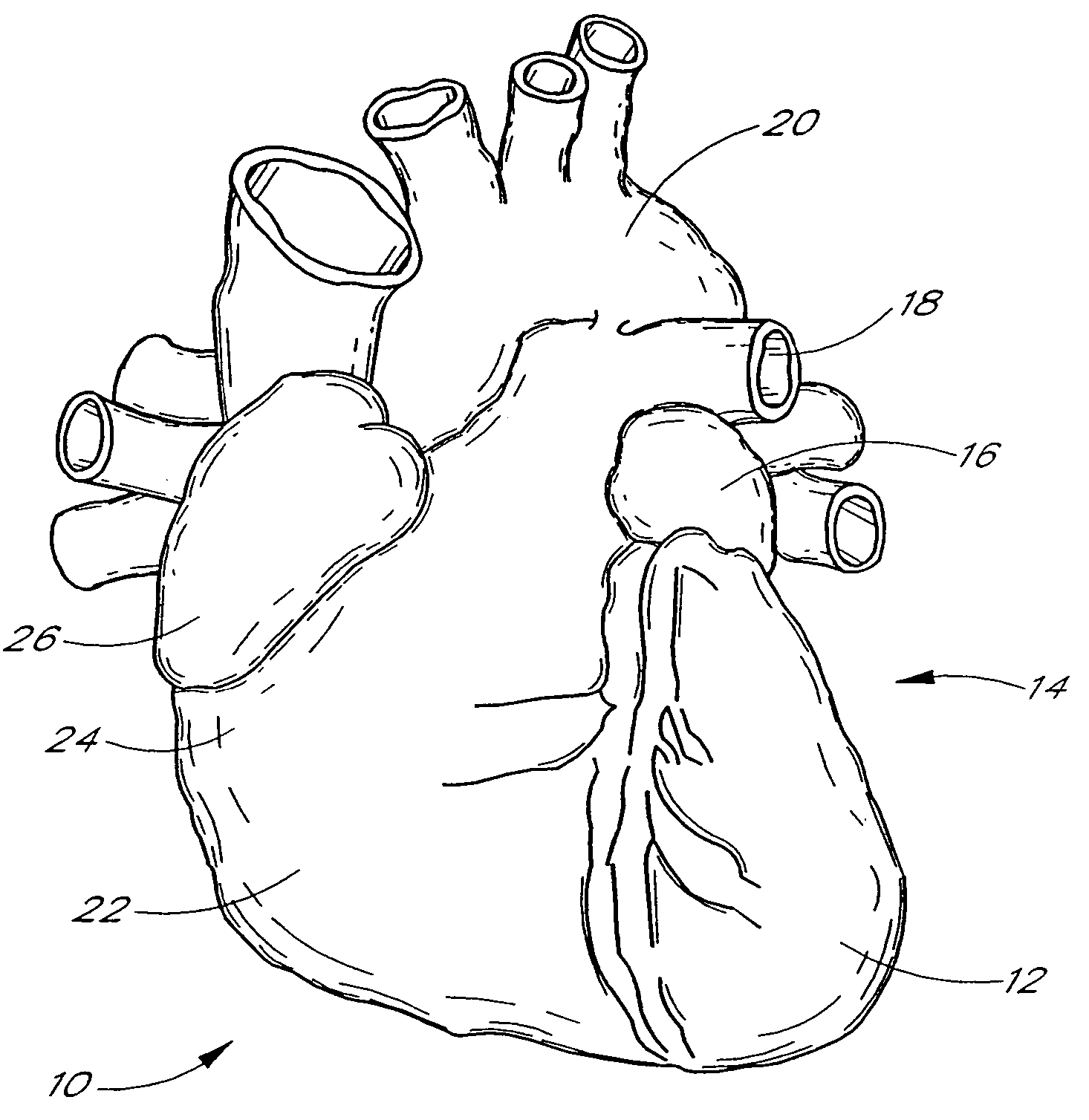 Method of securing tissue