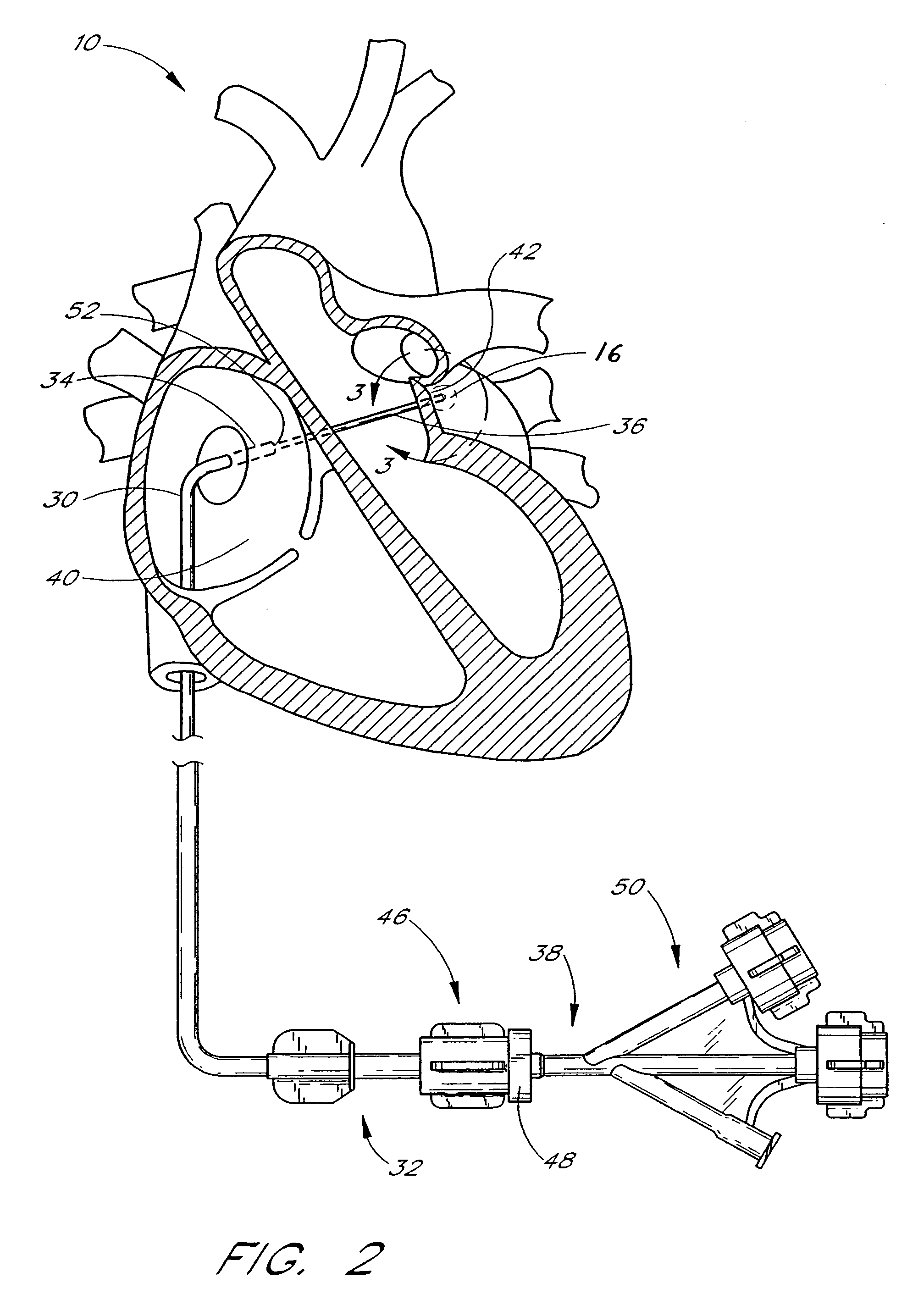 Method of securing tissue