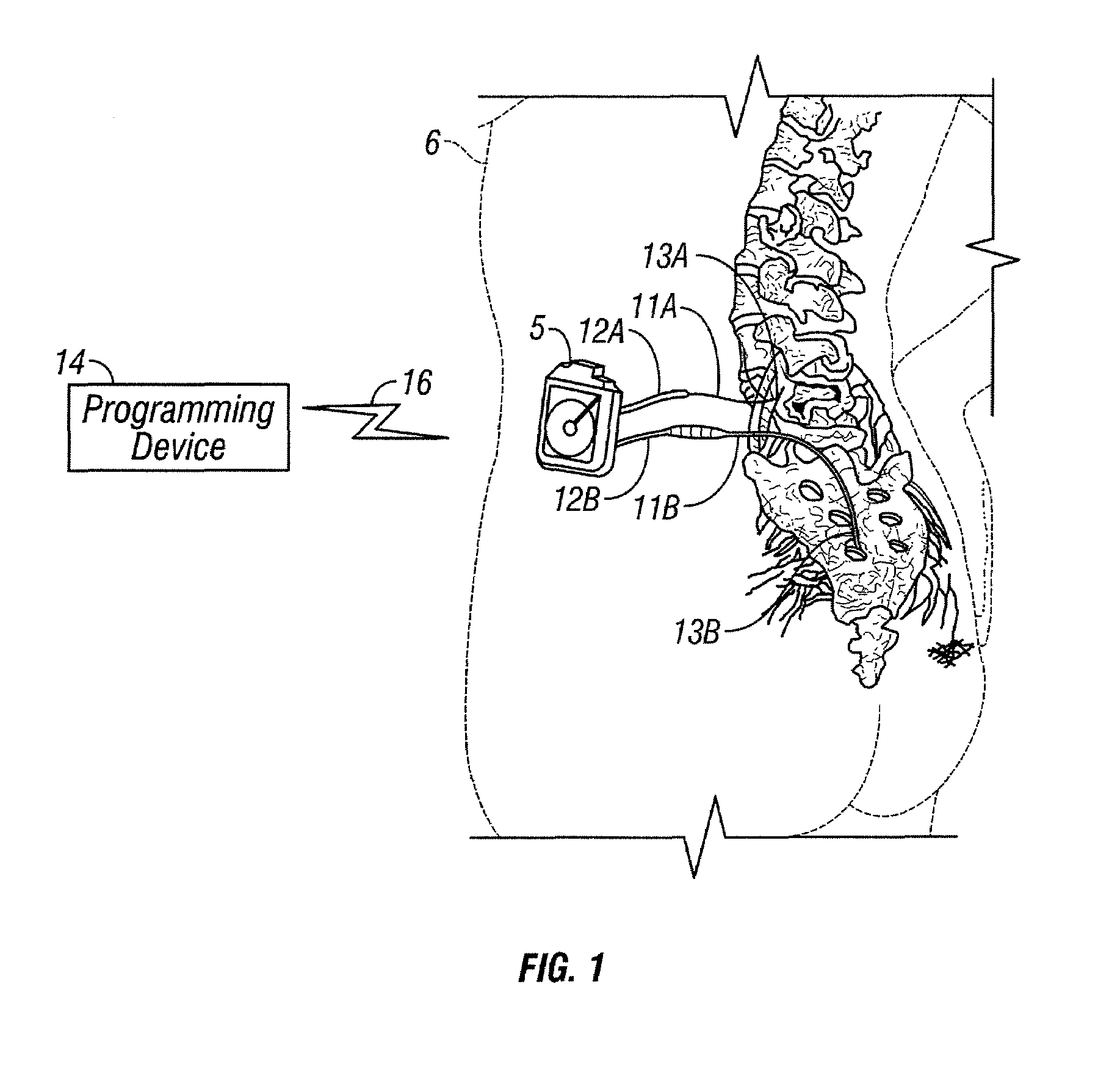 Human-implantable-neurostimulator user interface having multiple levels of abstraction