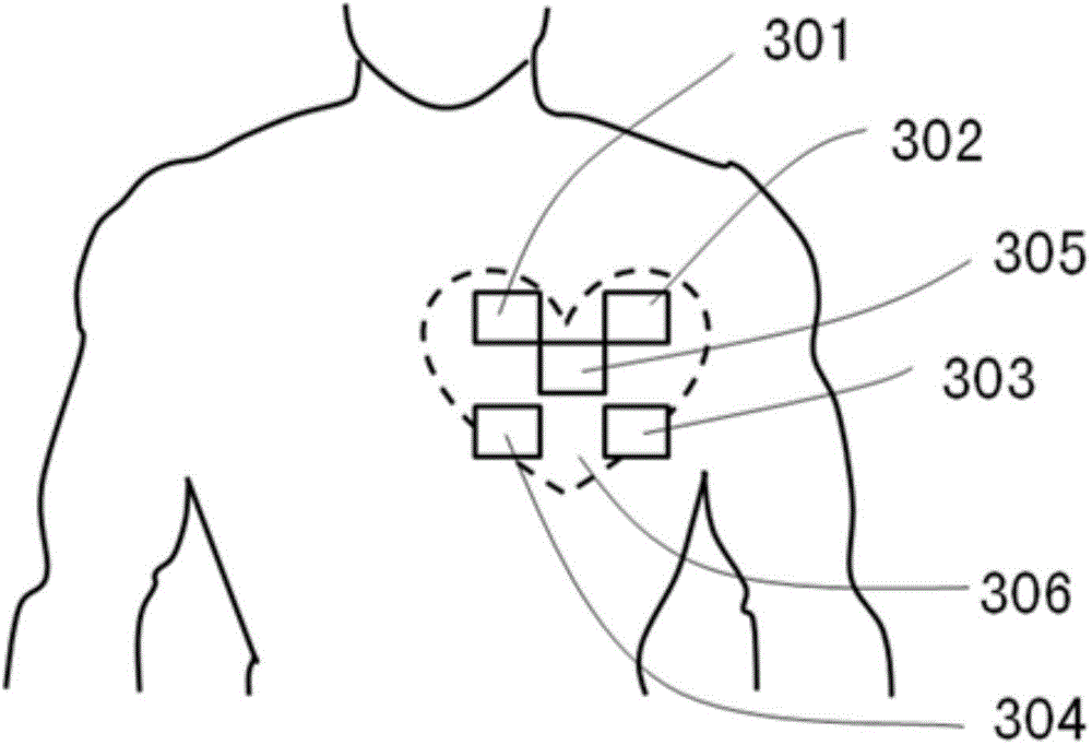 A system for identifying and diagnosing rheumatic heart disease based on sound sensors