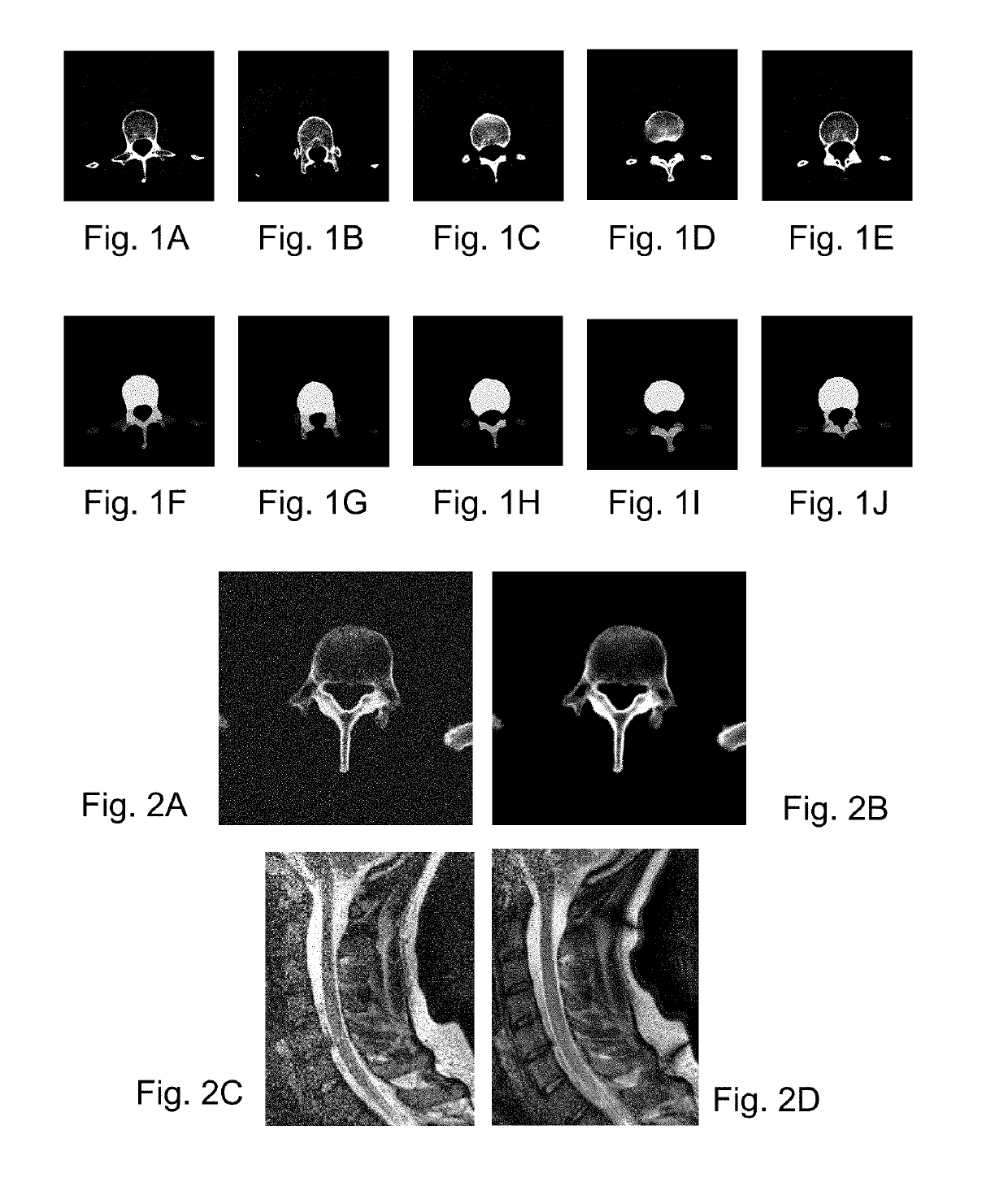 Automated segmentation of three dimensional bony structure images