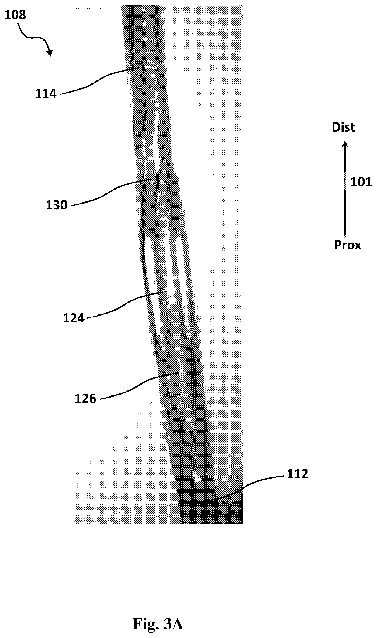 Devices for the removal of clots