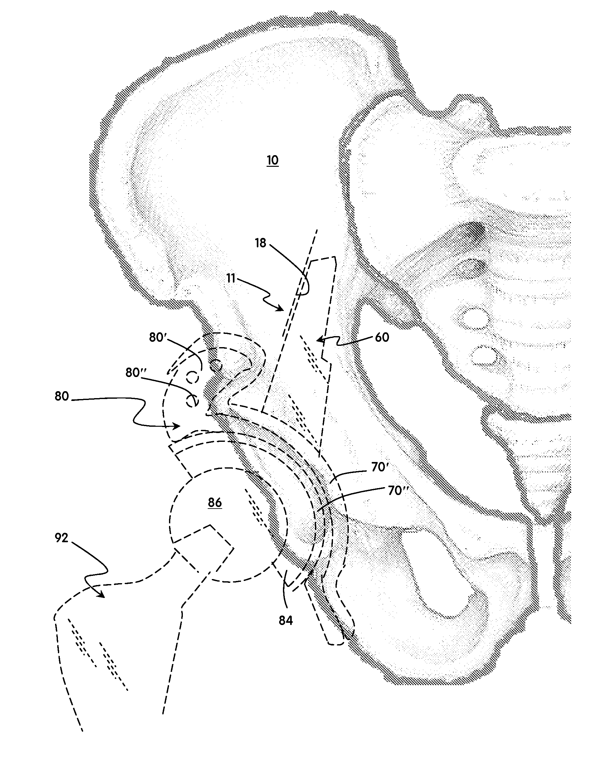 Methods and apparatus for acetabular arthroplasty