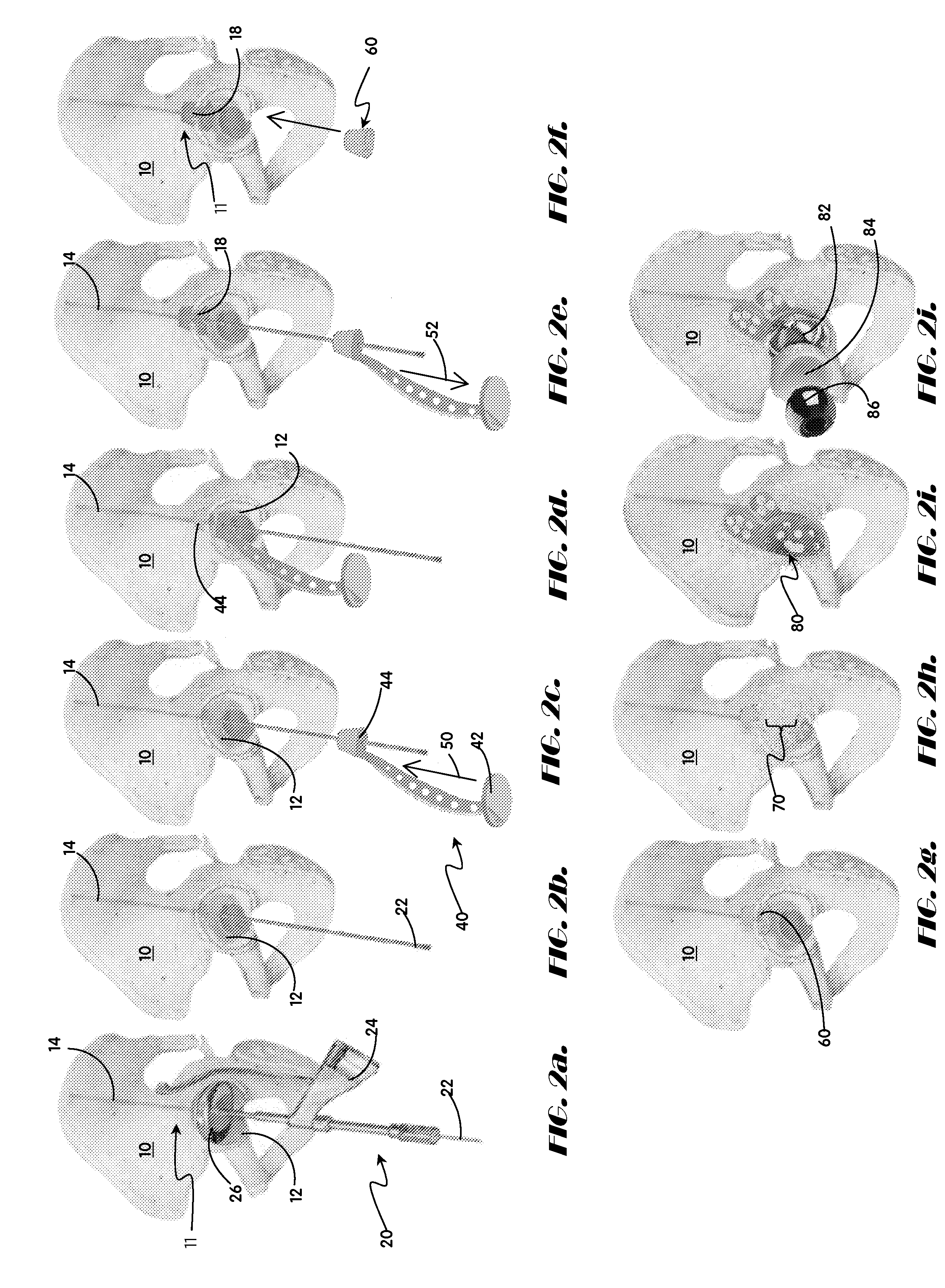 Methods and apparatus for acetabular arthroplasty