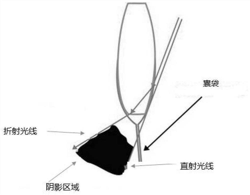 A Posterior Chamber Lens with Toric Surface Design