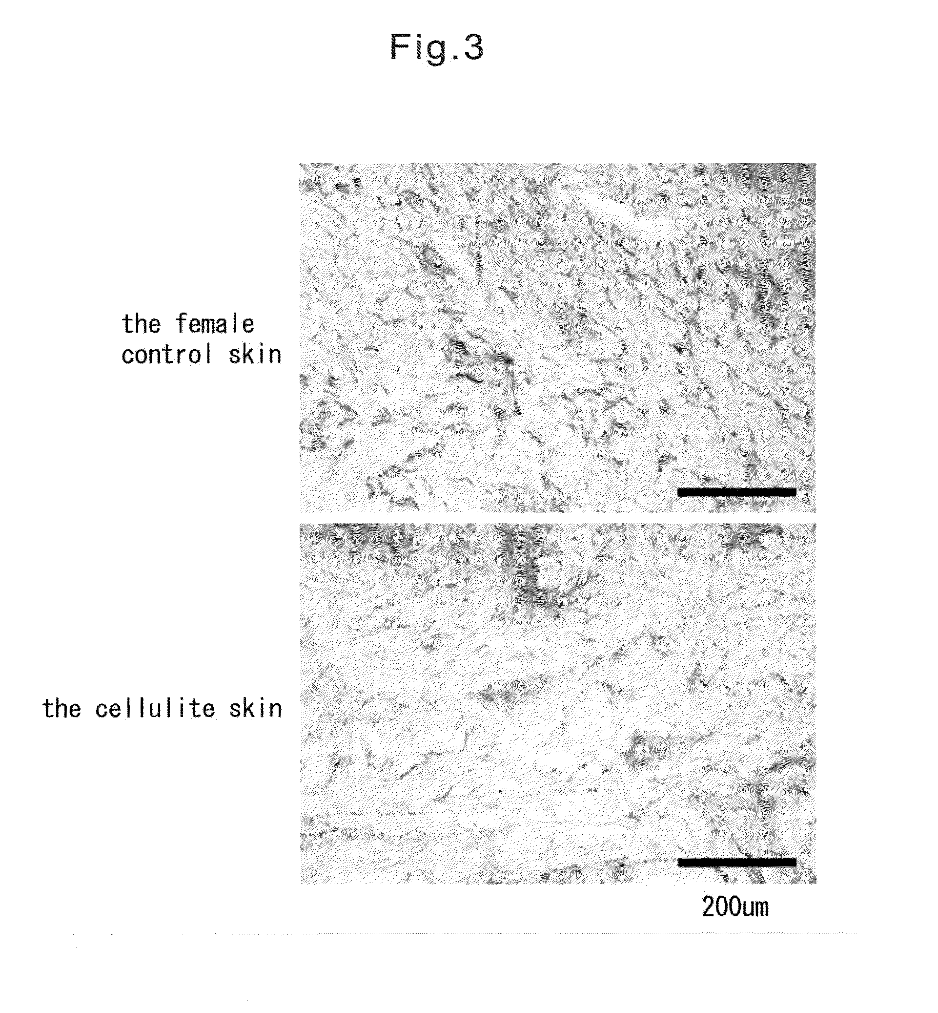 Method of evaluating cellulite and method of evaluating cellulite-effective drug using fibulin-3 and/or sarcoglycan gamma as an indicator