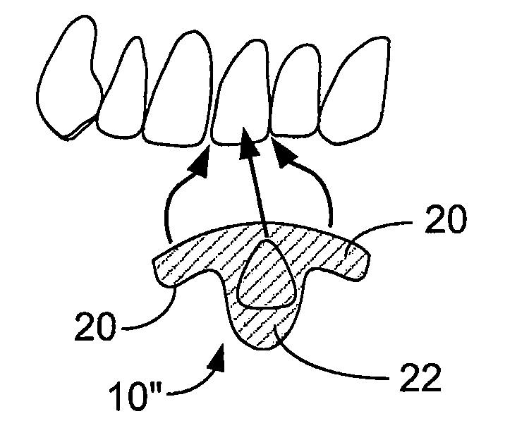 Dental composite delivery system