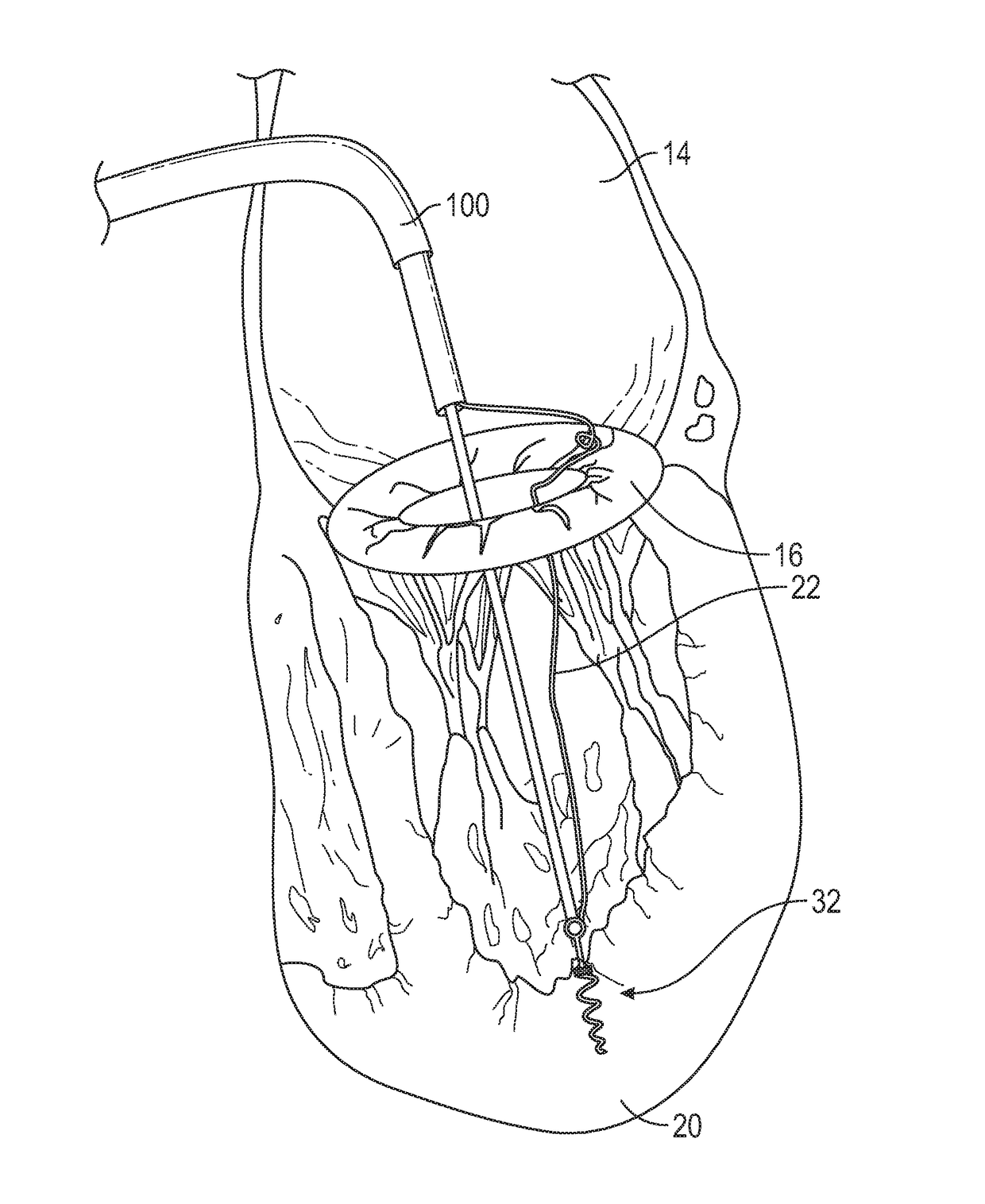 Method for transvascular implantation of neo chordae tendinae