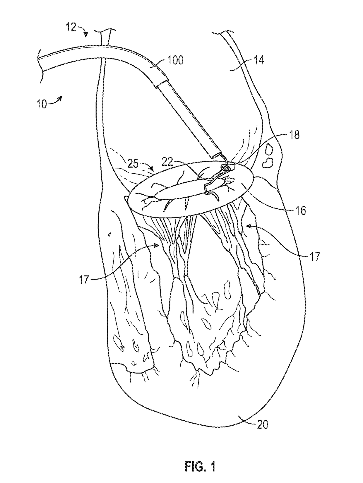 Method for transvascular implantation of neo chordae tendinae