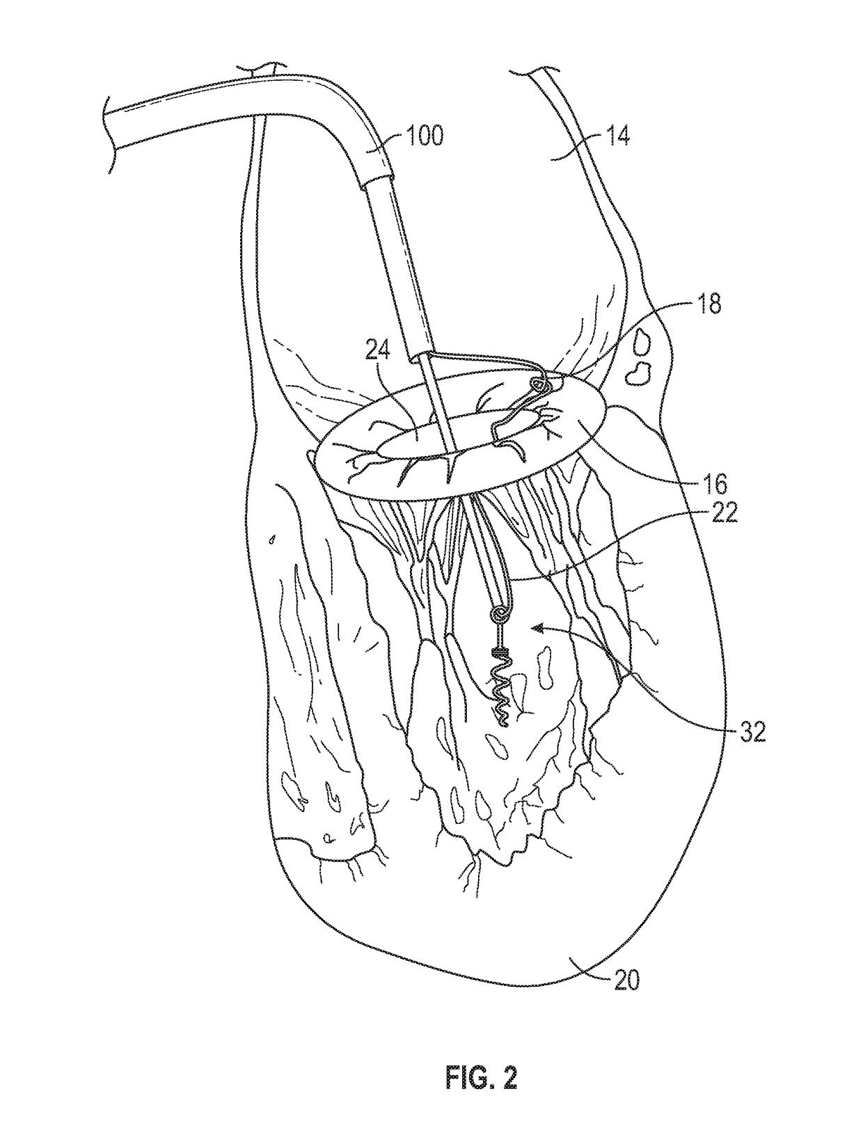 Method for transvascular implantation of neo chordae tendinae