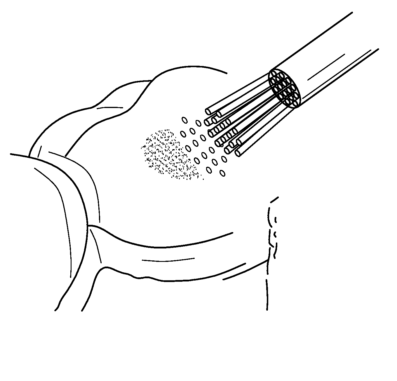 Probes and biofluids for treating and removing deposits from tissue surfaces