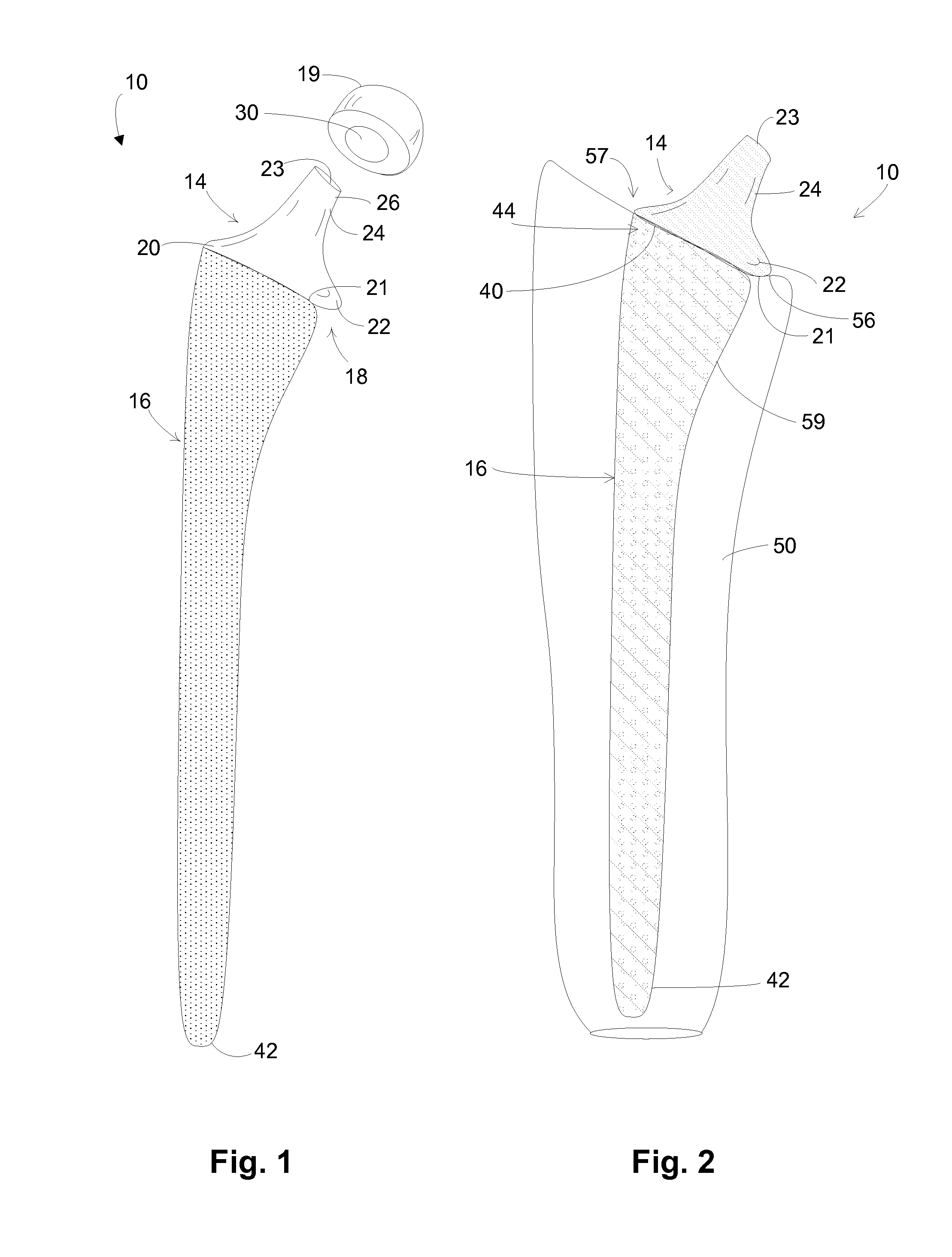 Hip implant with porous body