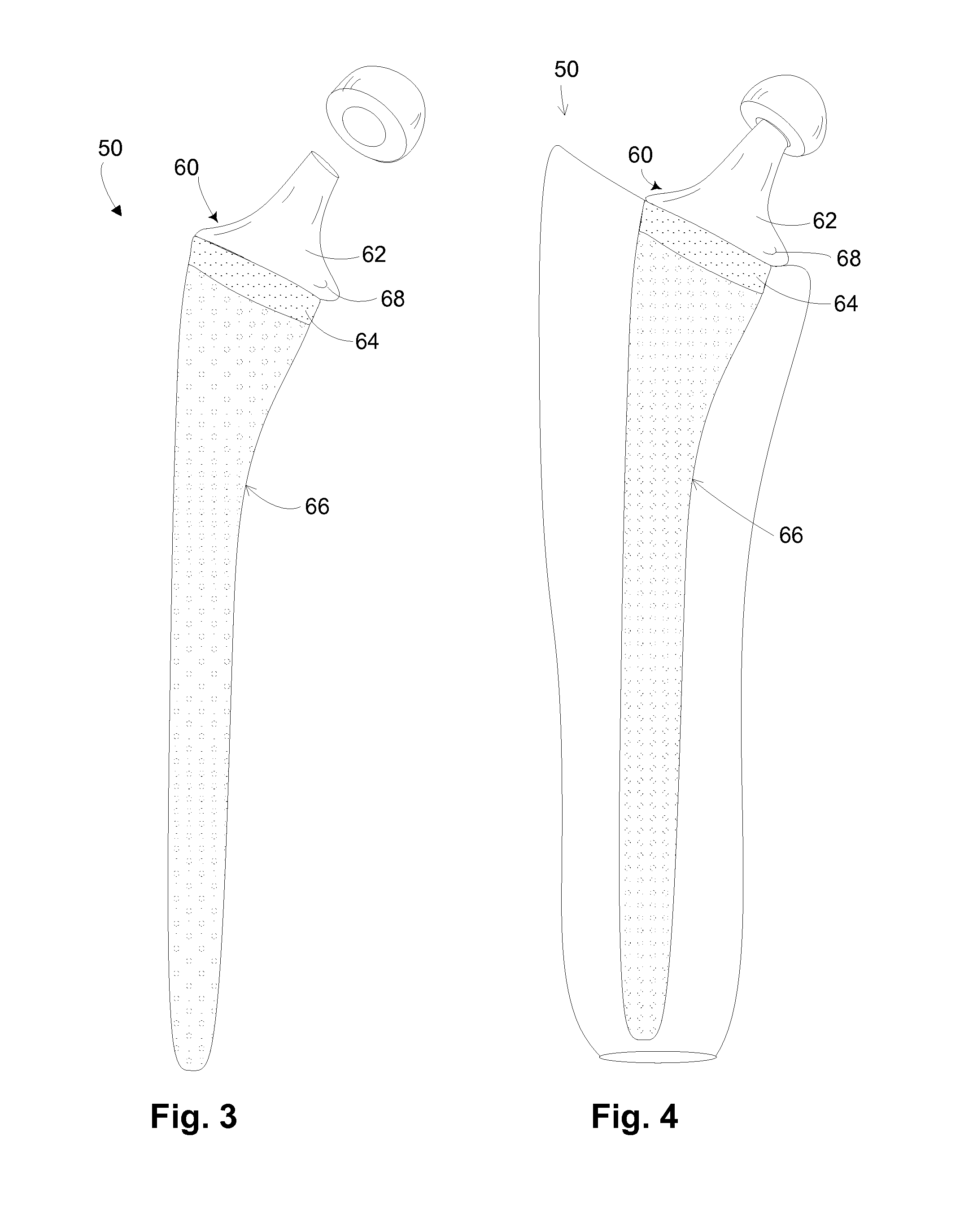 Hip implant with porous body