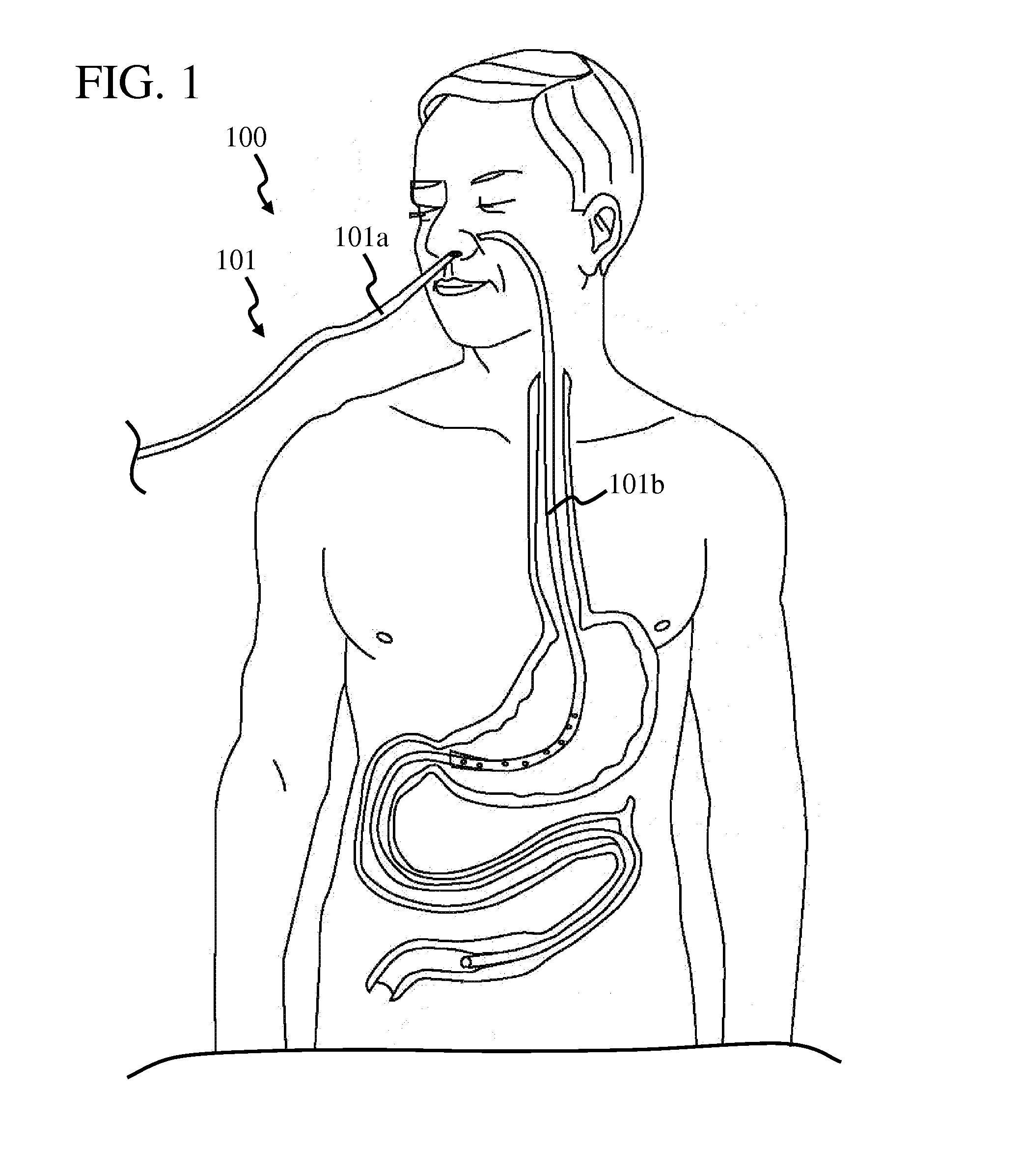 Reinforced enteral feeding catheter