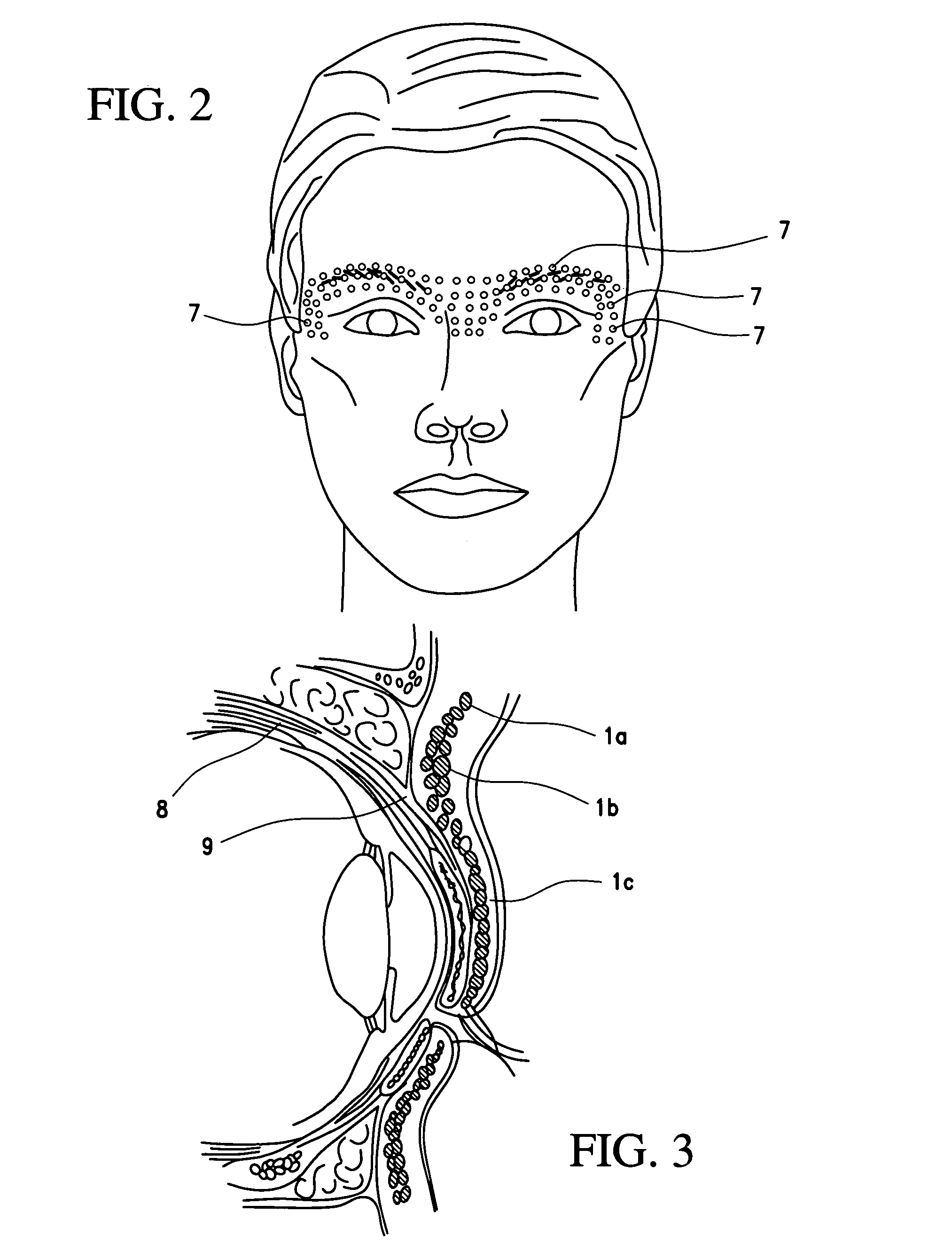 Cosmetic use of botulinum toxin for the treatment of eyebrow and forehead ptosis, and unwanted eyebrow expression