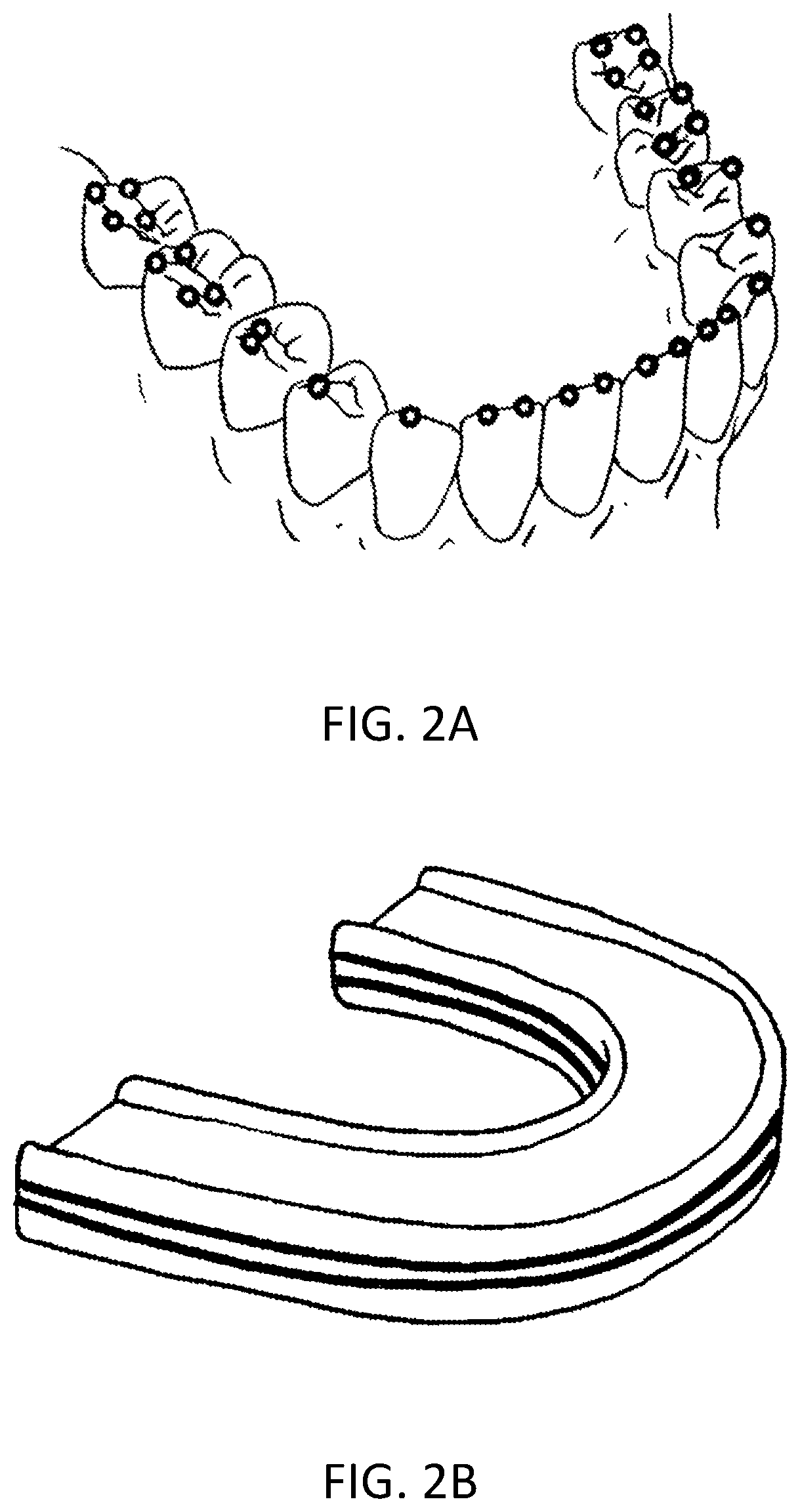 Capacitive sensor array for dental occlusion monitoring