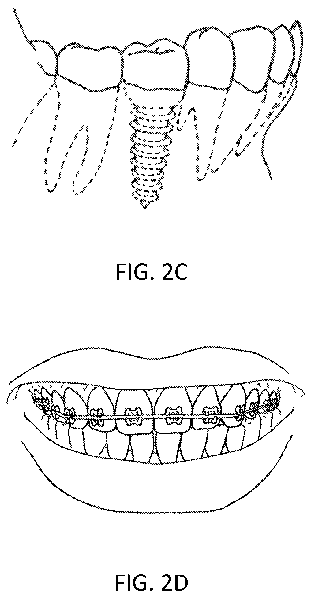 Capacitive sensor array for dental occlusion monitoring