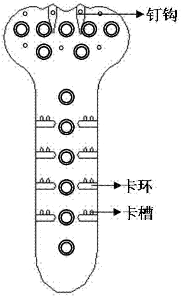 Anatomical locked hook plate with memory alloy