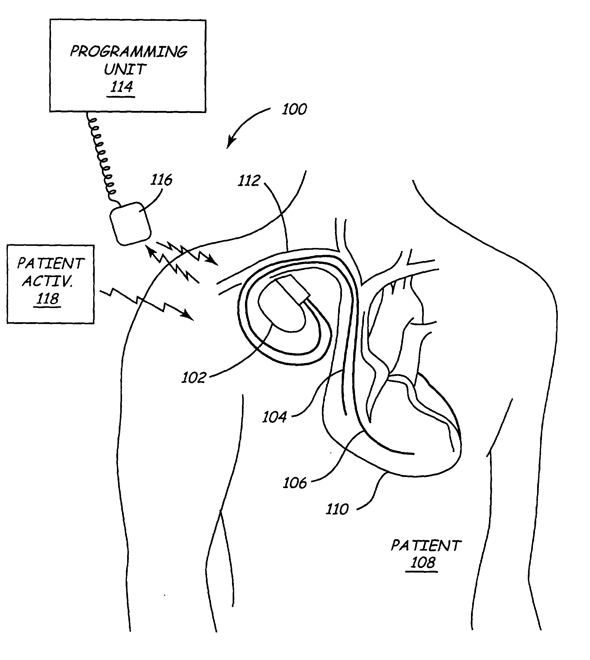 Implantable medical device (IMD) system configurable to subject a patient to a stress test and to detect myocardial ischemia within the patient