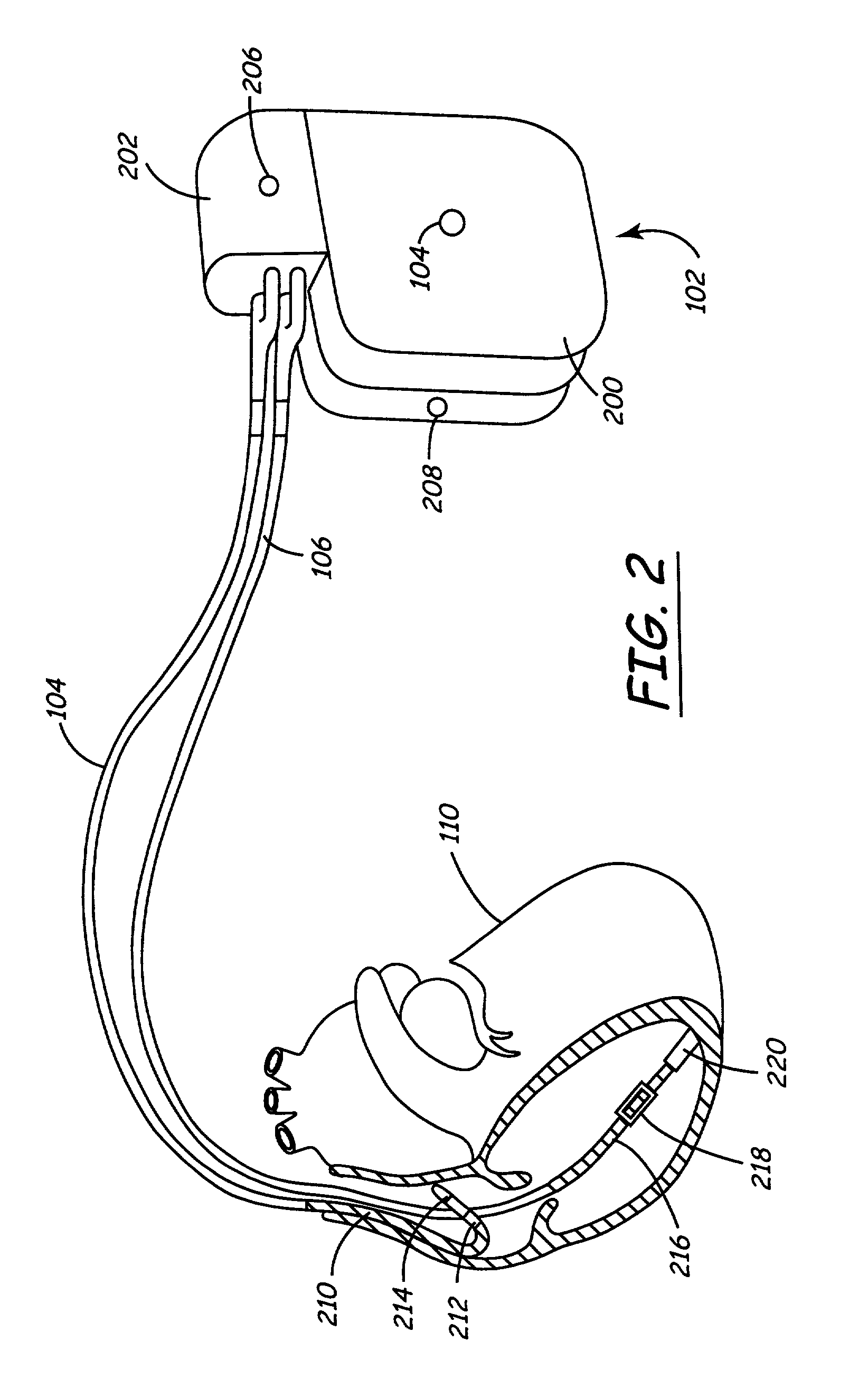 Implantable medical device (IMD) system configurable to subject a patient to a stress test and to detect myocardial ischemia within the patient