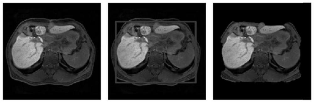 Medical image segmentation method based on interactive foreground extraction and information entropy watershed