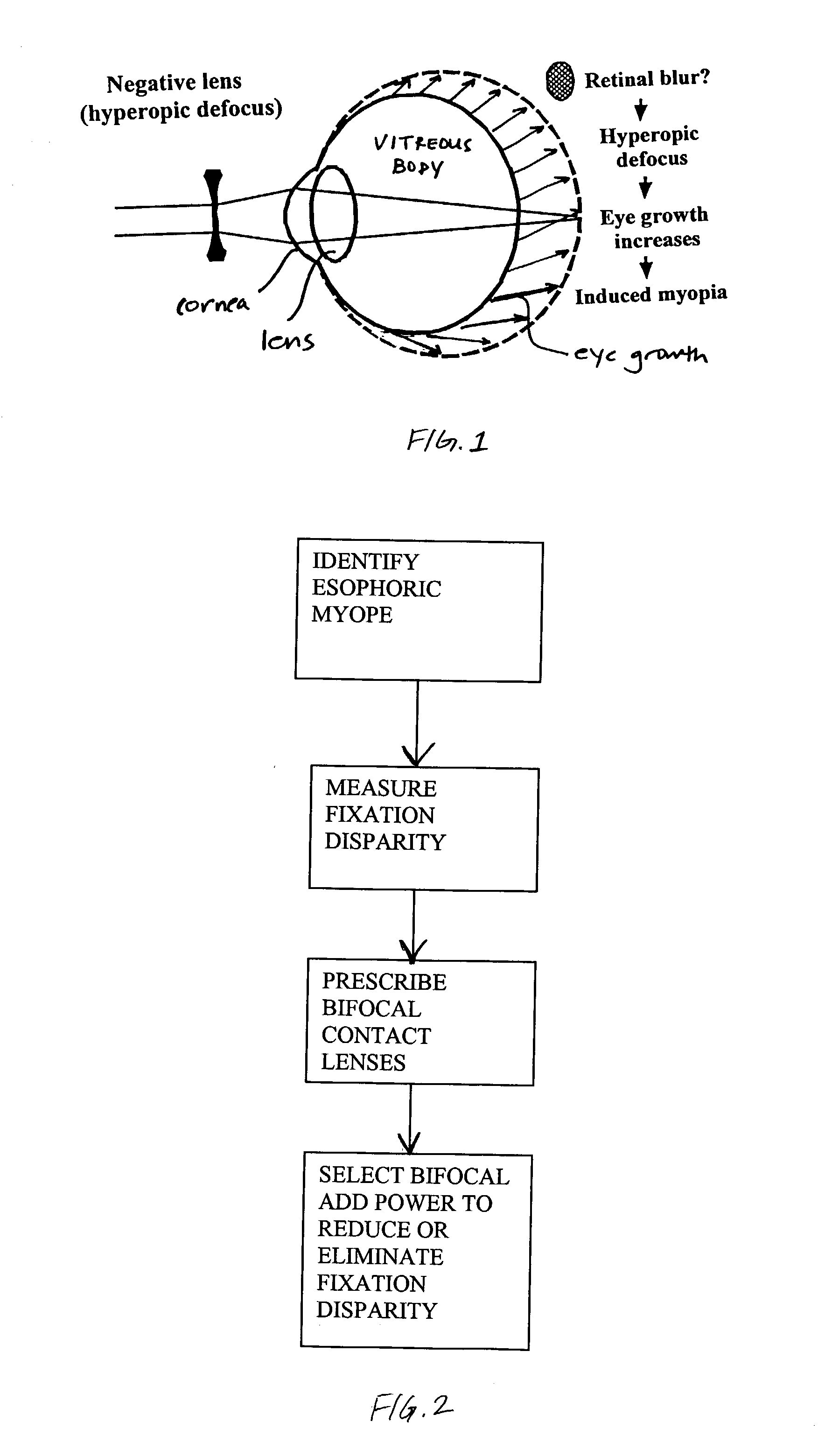 Myopia progression control using bifocal contact lenses