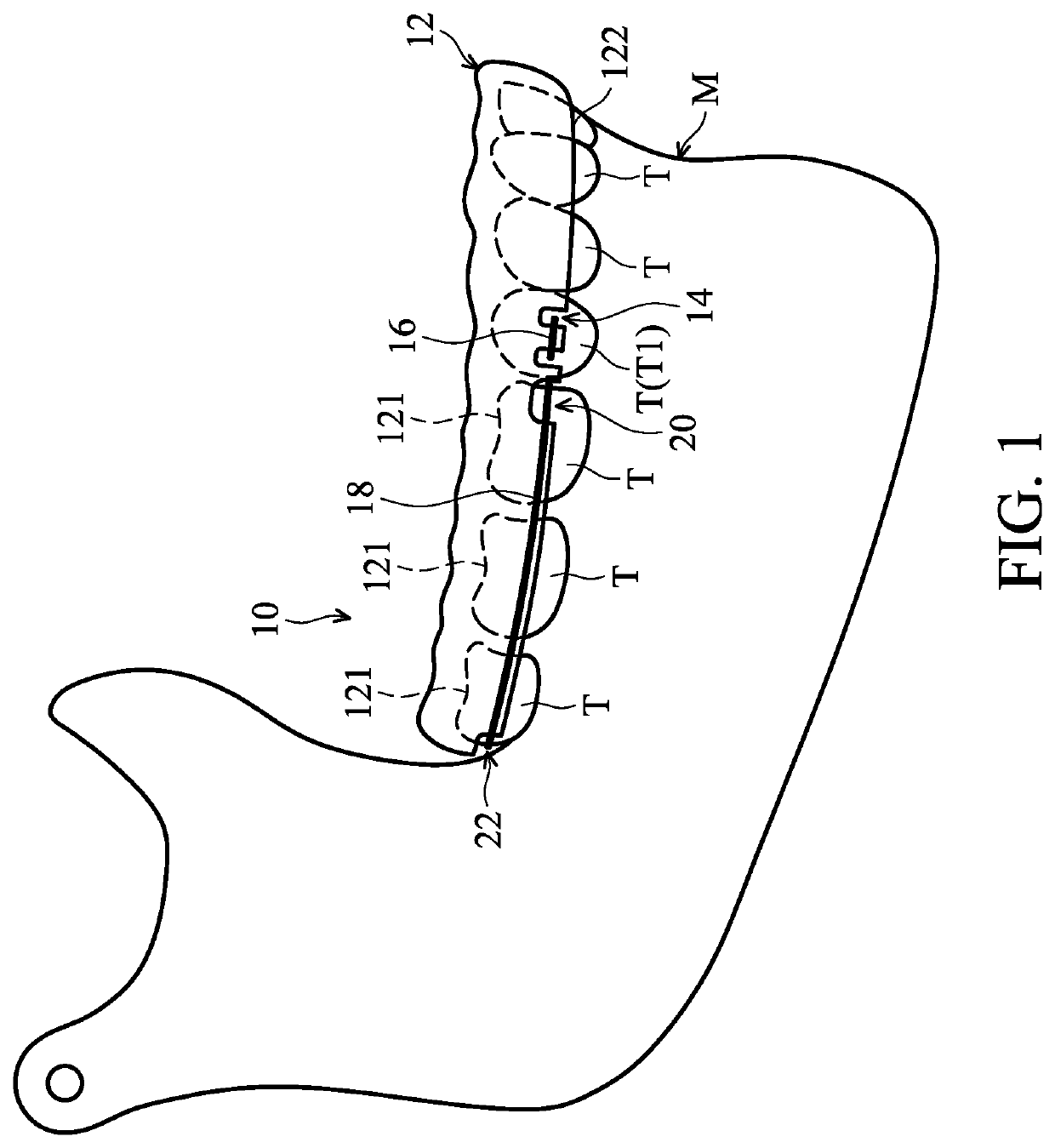 Orthodontic correction device