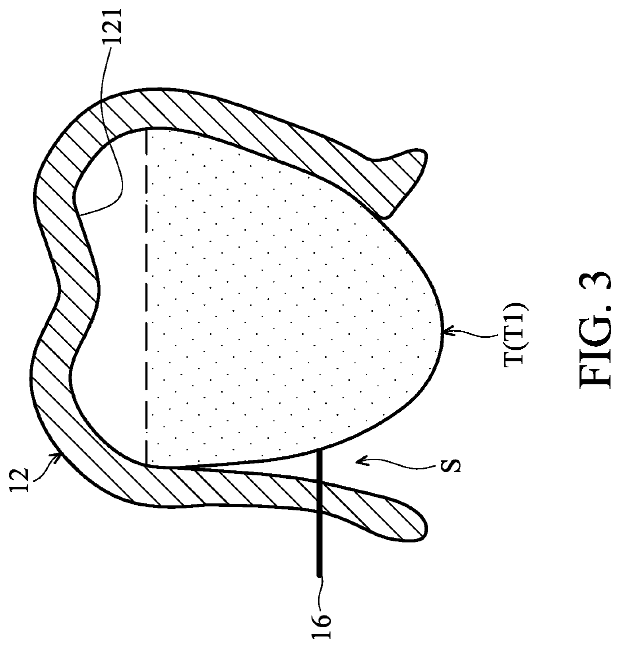 Orthodontic correction device