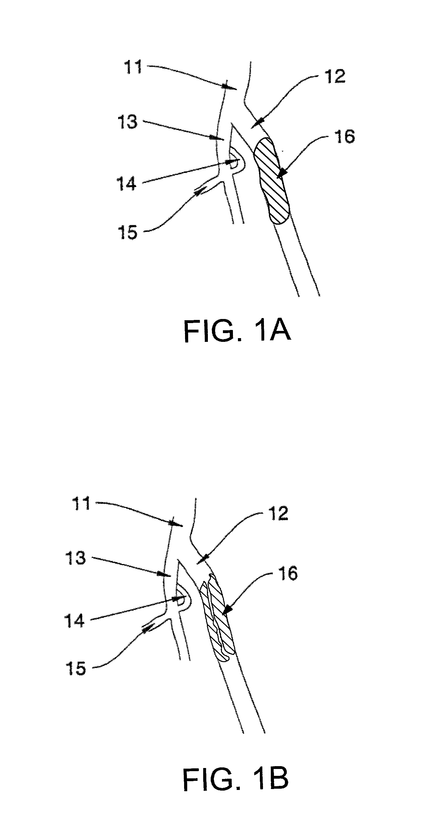 Catheter devices and methods for their use in the treatment of calcified vascular occlusions