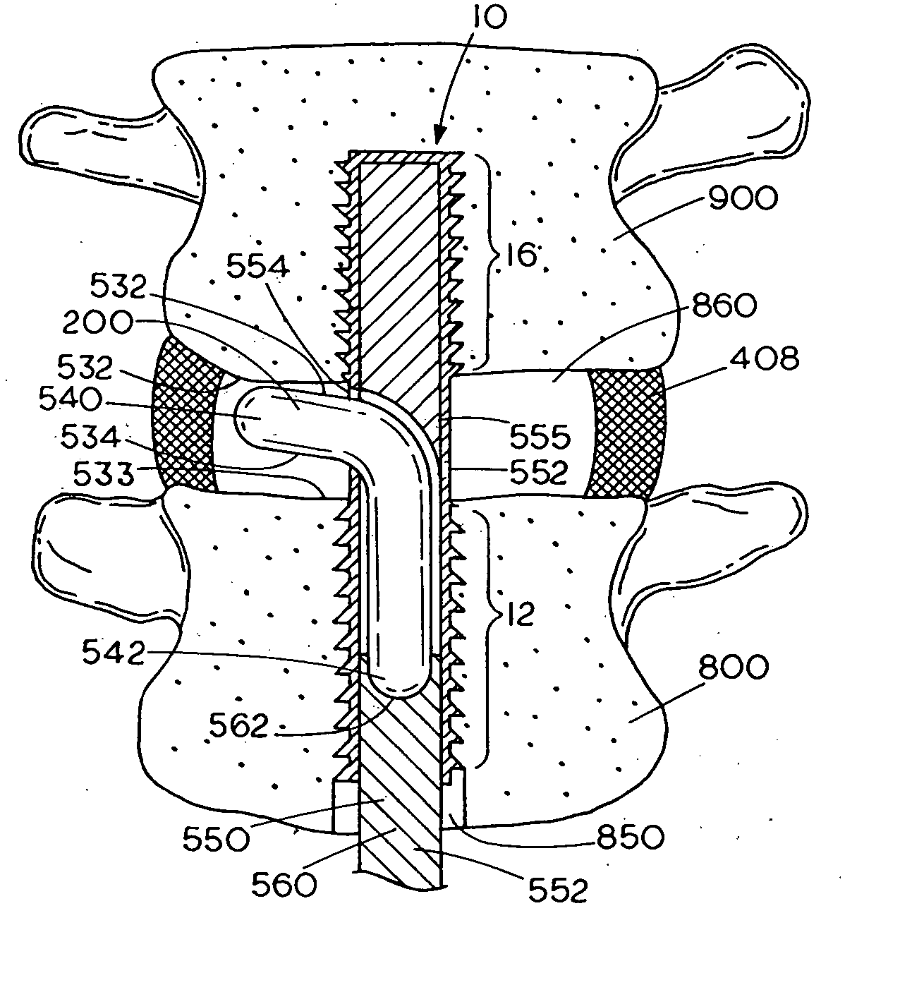 Spinal mobility preservation apparatus