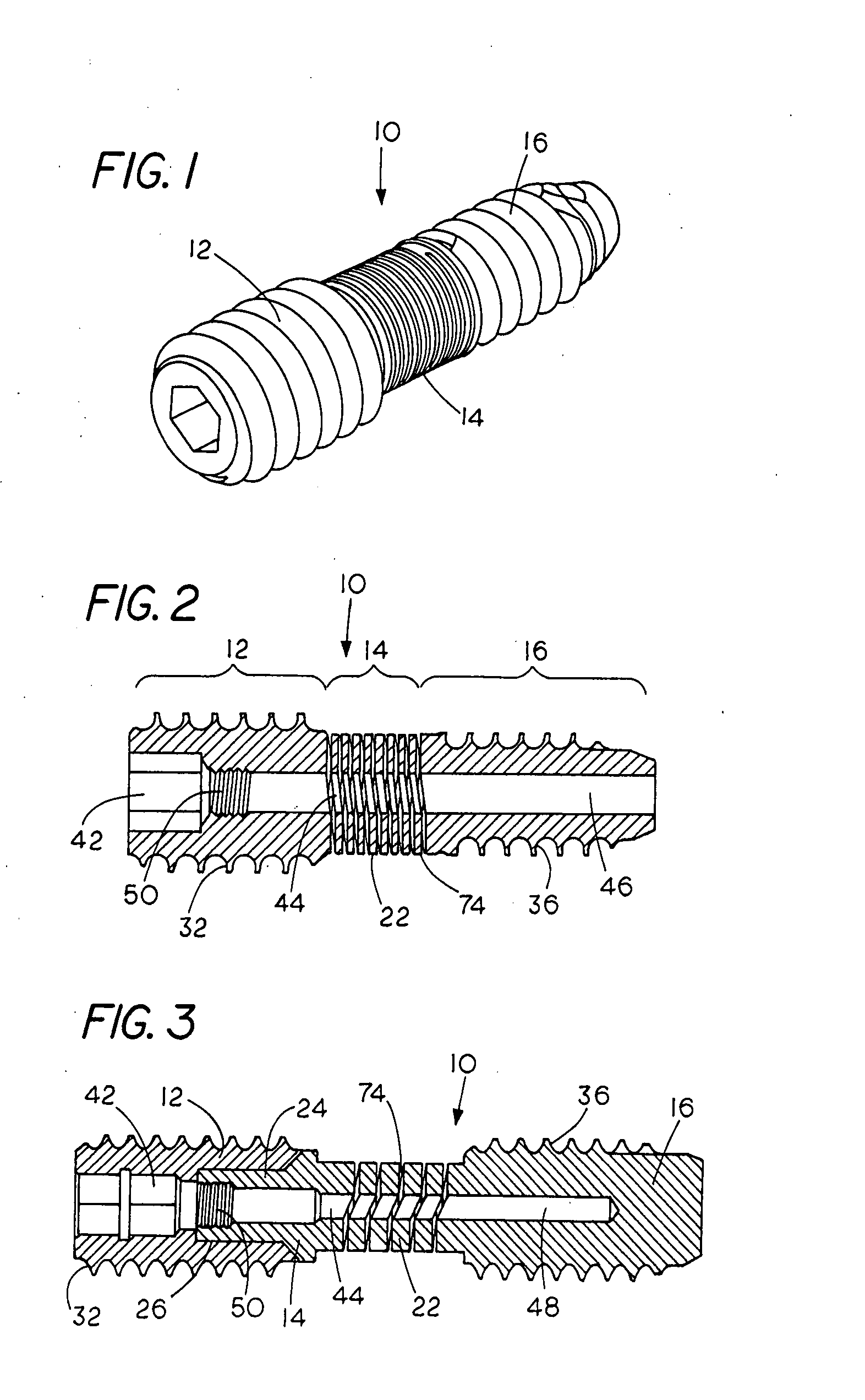 Spinal mobility preservation apparatus