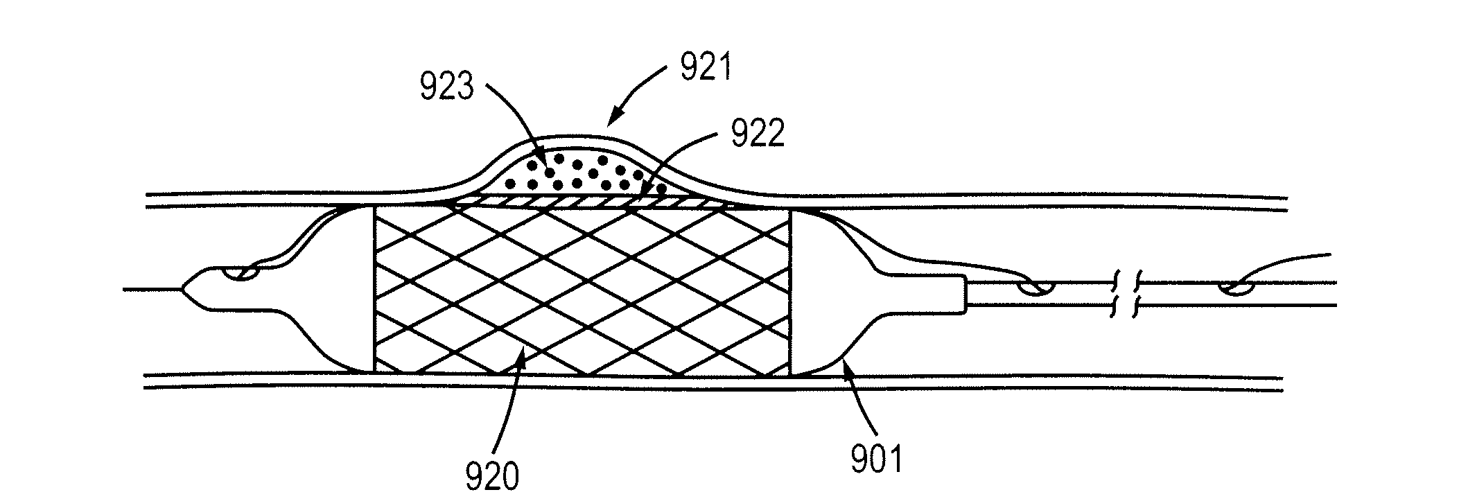 Methods and apparatuses for coating a lesion