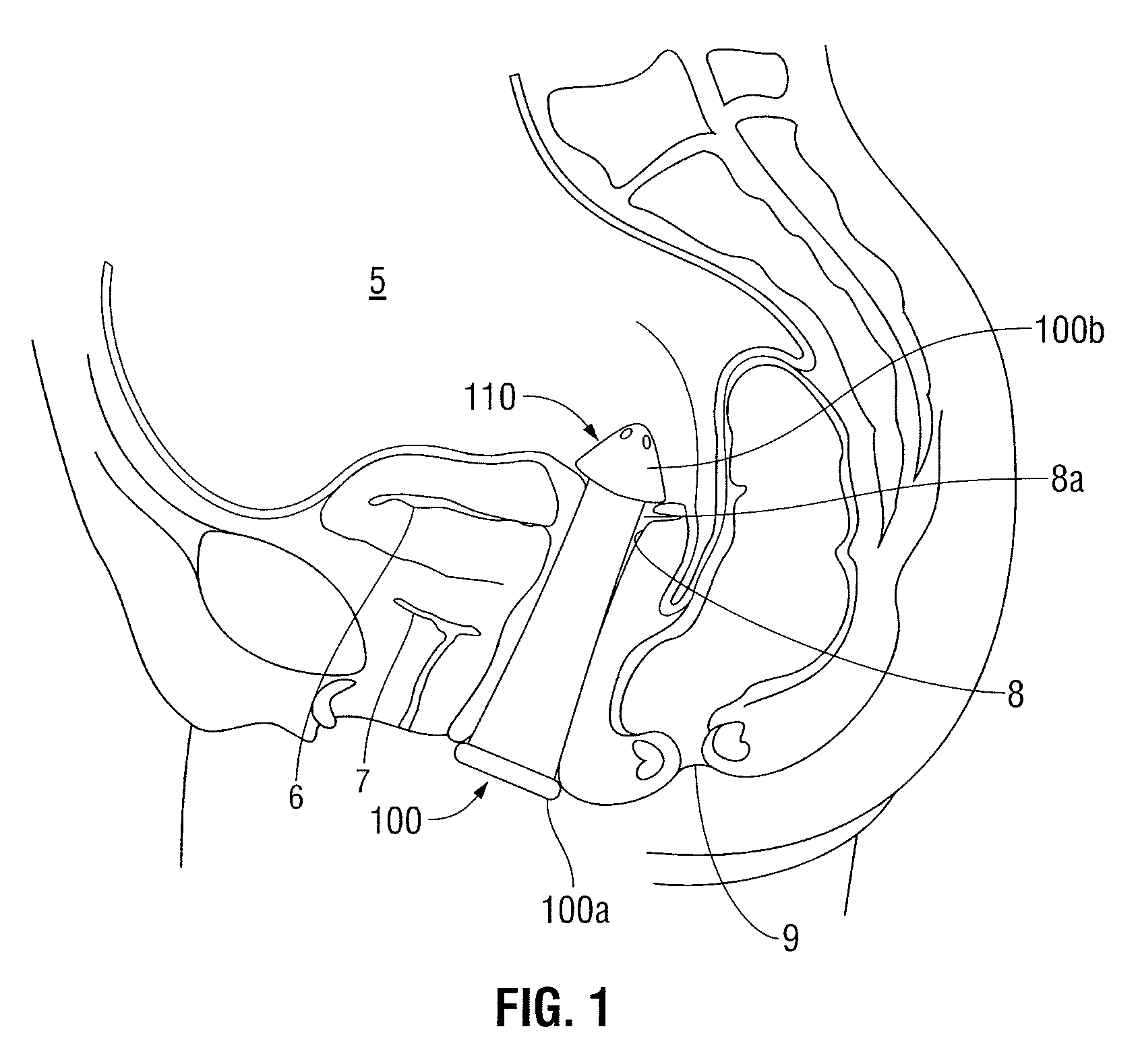 Apparatus and method for transvaginal surgery