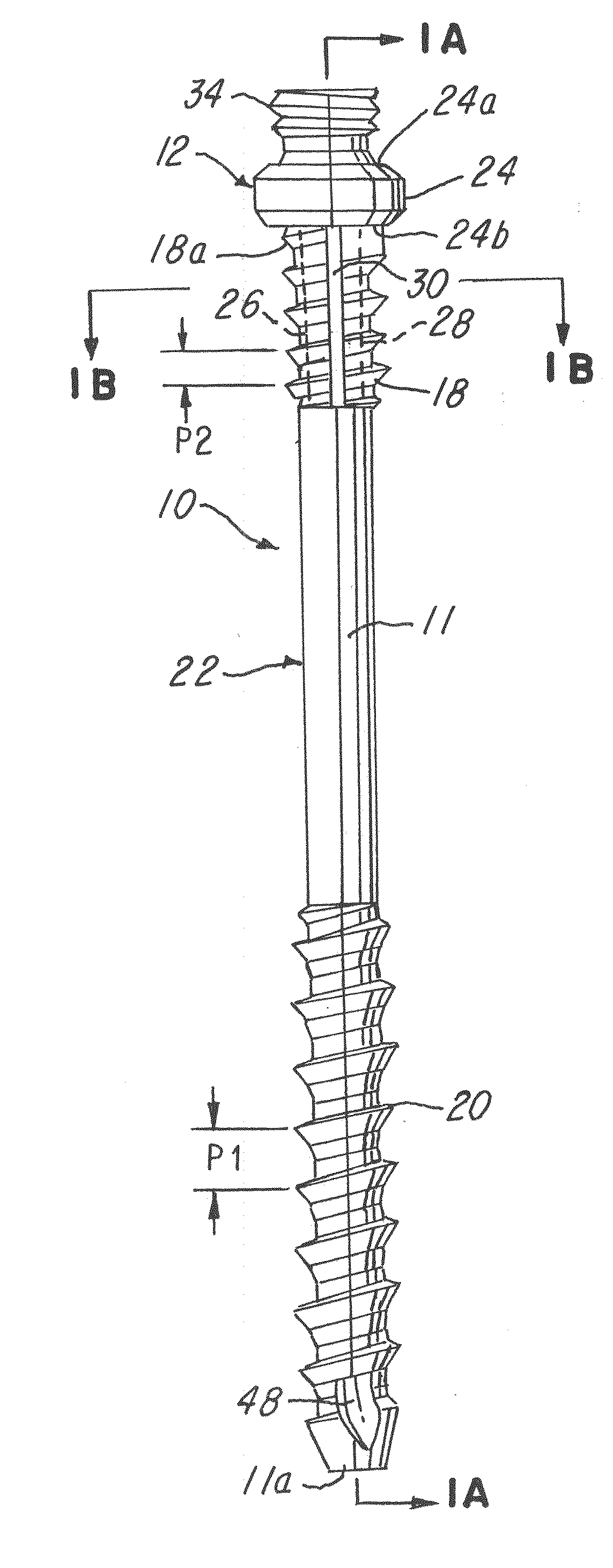 Minimally invasive spinal facet compression screw and system for bone joint fusion and fixation