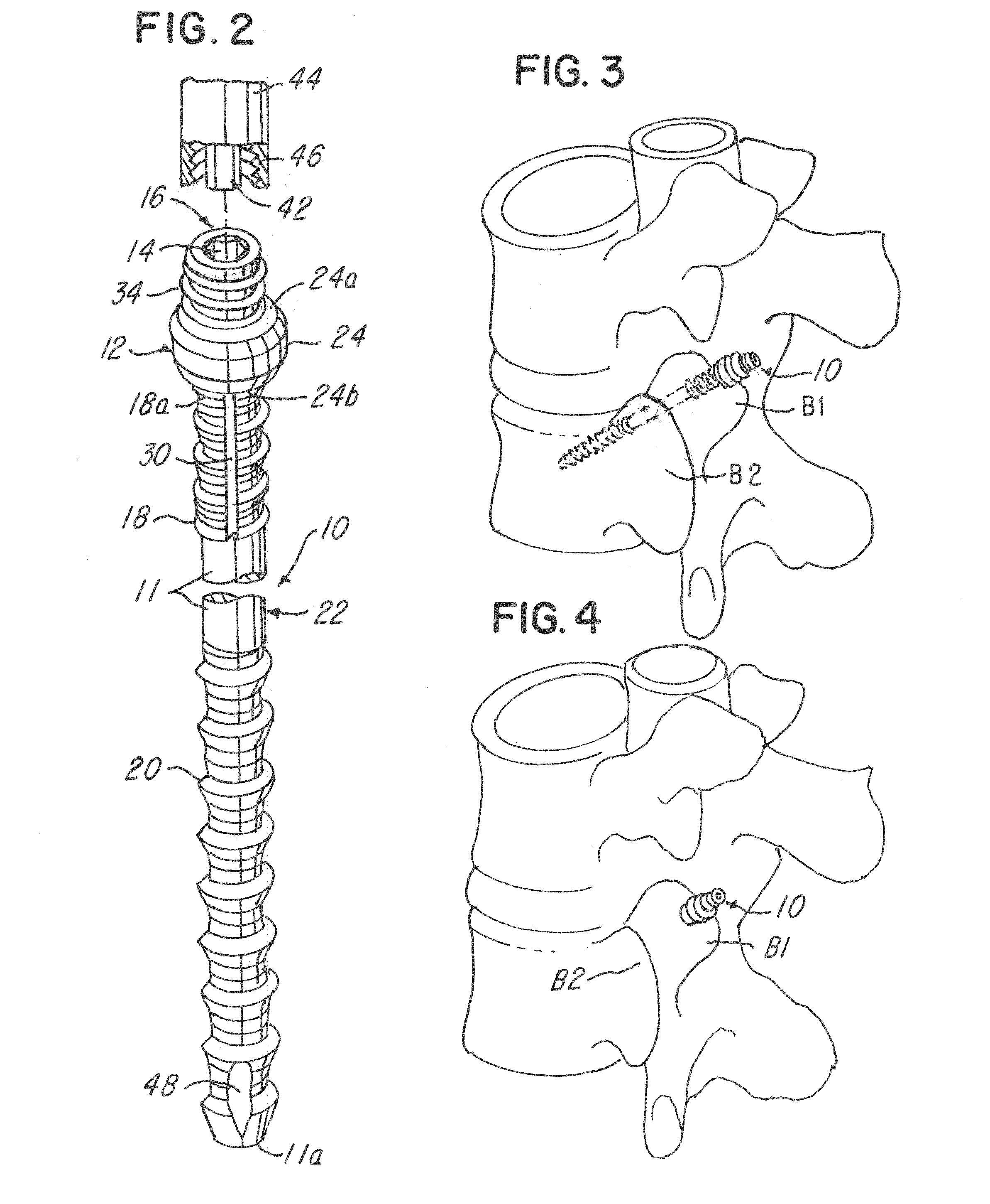 Minimally invasive spinal facet compression screw and system for bone joint fusion and fixation