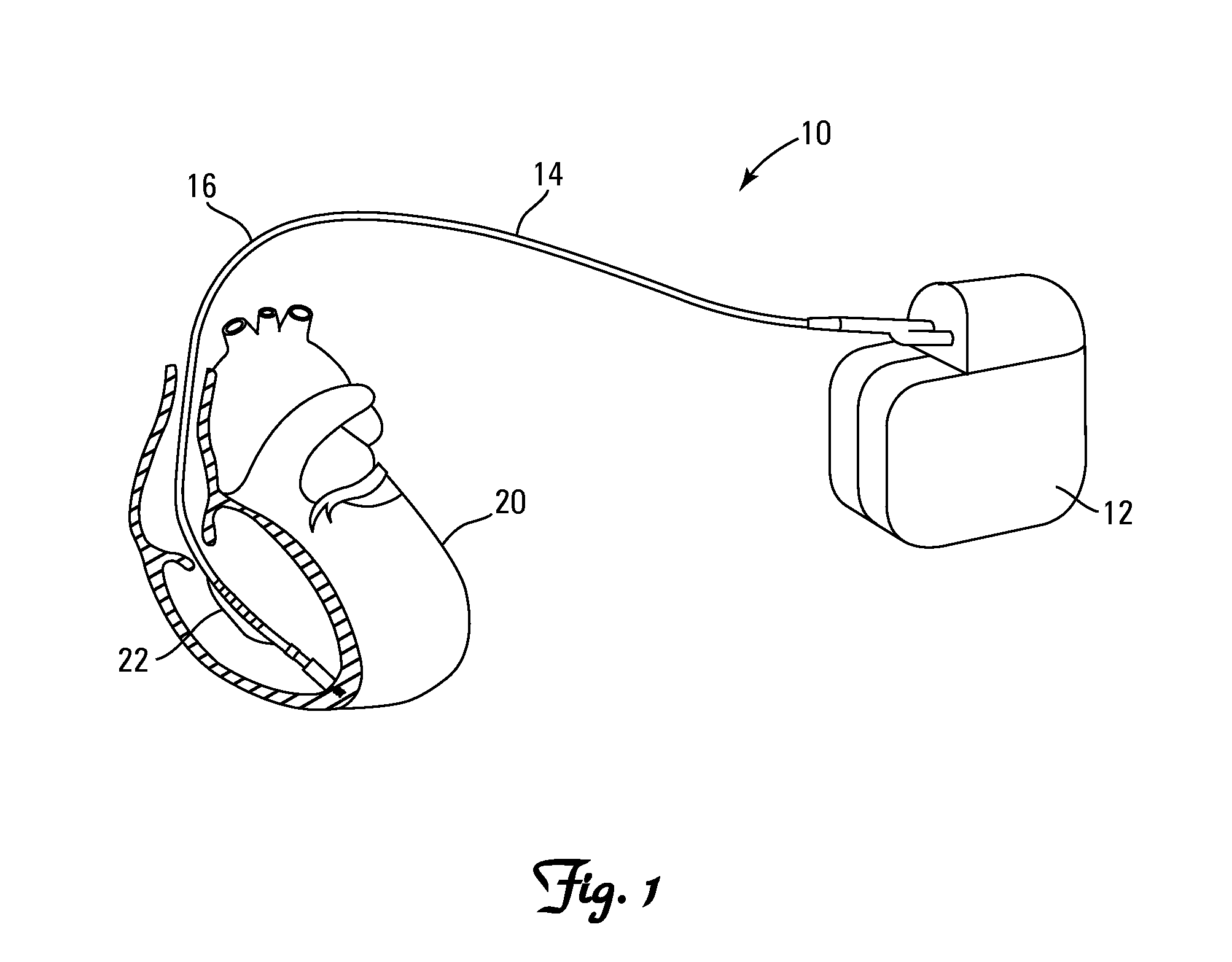 Method and Apparatus for Implantable Cardiac Lead Integrity Analysis