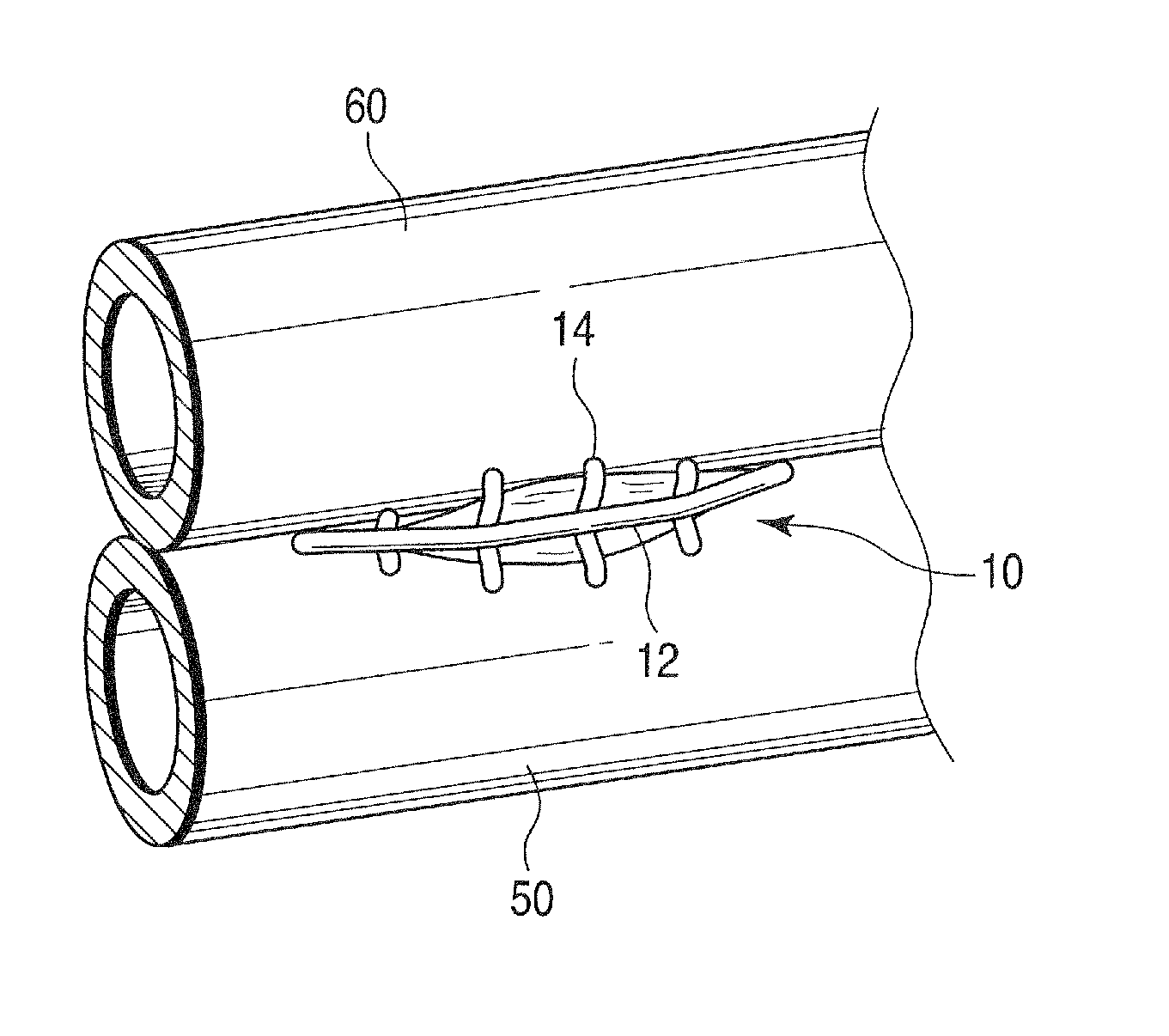 Hollow tissue inosculation apparatus