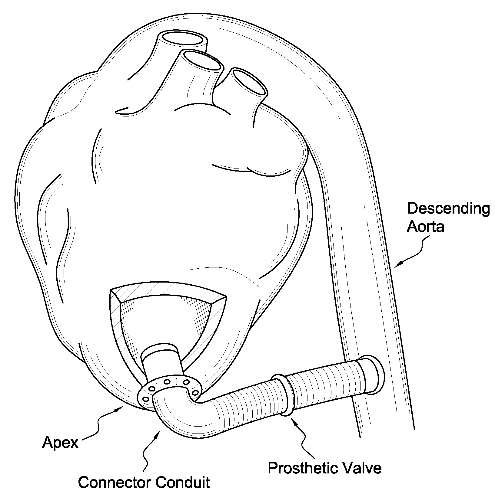 Apparatus and method for suturelessly connecting a conduit to a hollow organ