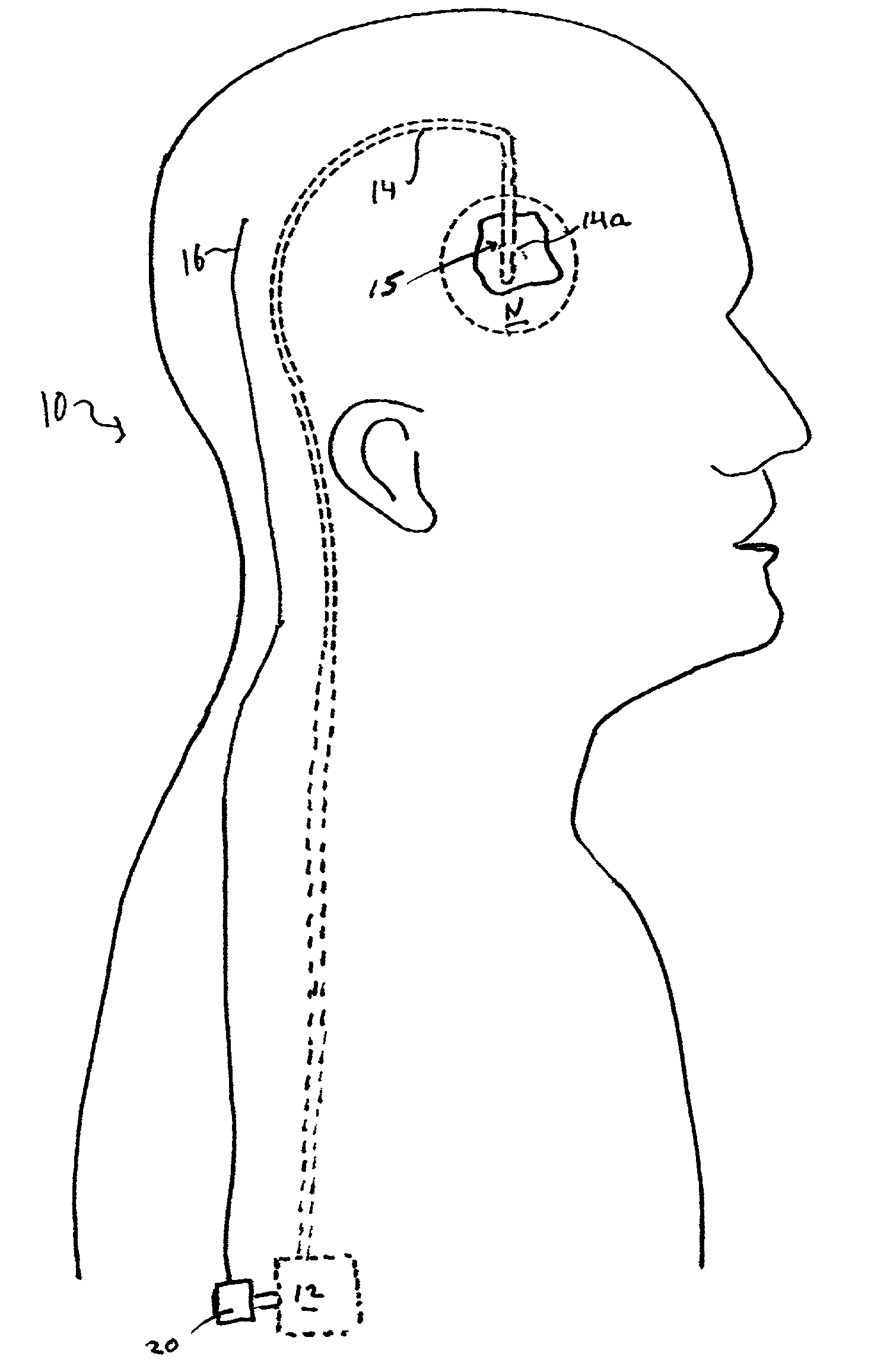 Closed-loop drug delivery system