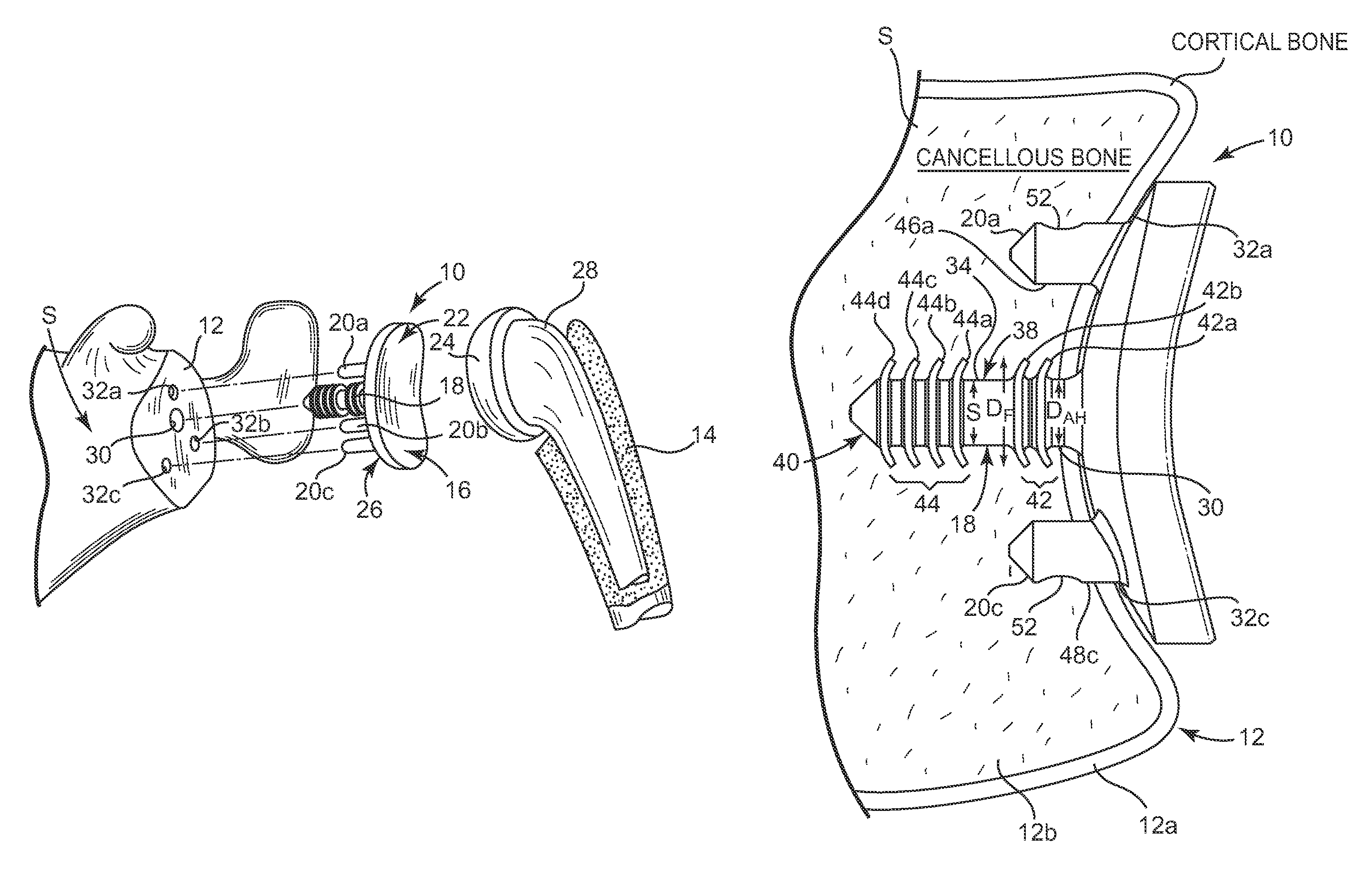 Glenoid implant anchor post